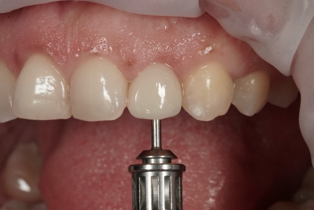A #singleimplant case with a proper #emergenceprofile . A #provisionalcrown was fabricated following osseointegration .
#implantology #implantdentistry