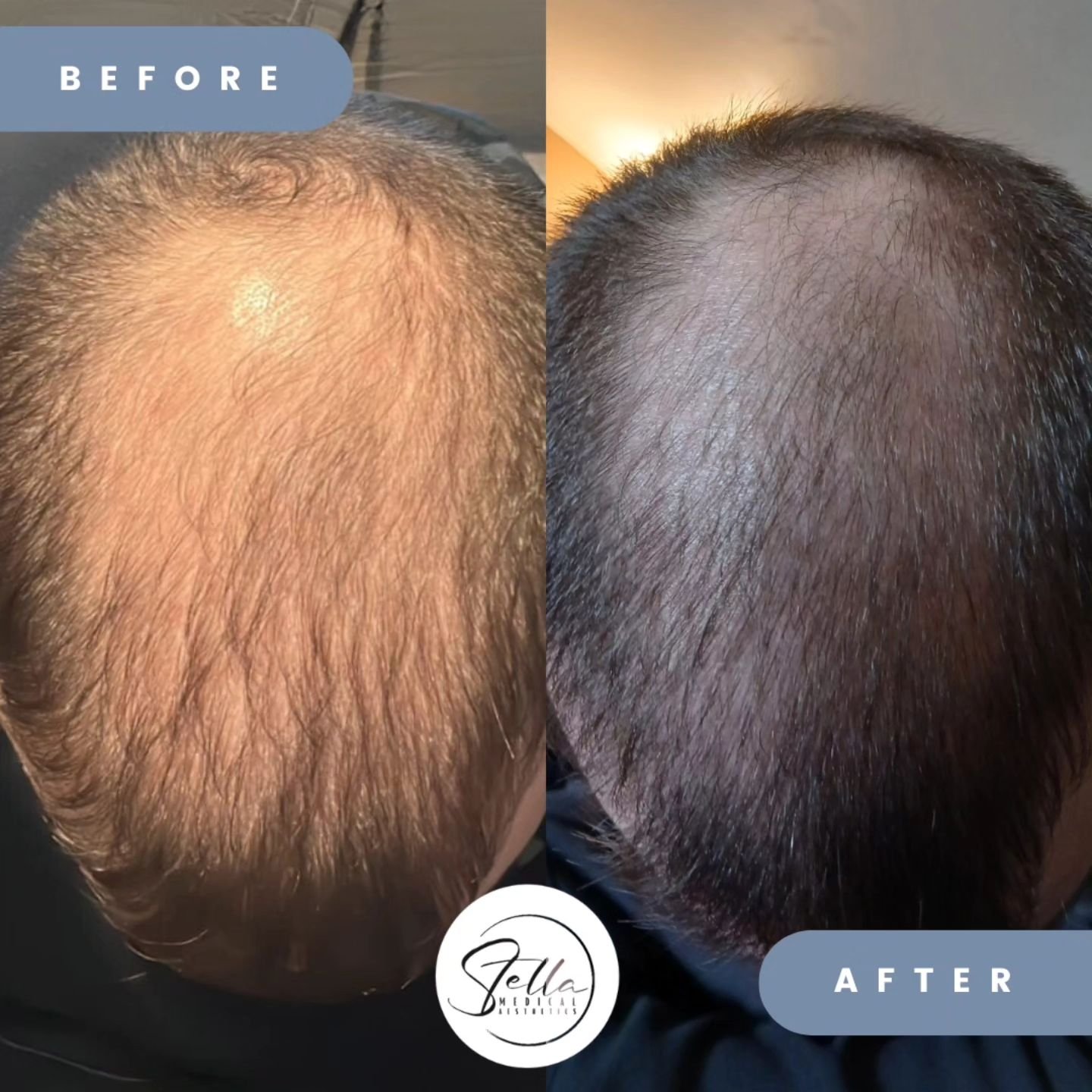 Are you thinking about having thicker healthier locks? Would you love to go
 🦲 from thin to thick 🦱 ?
Well PRP delivers stunning results for hair restoration!

After just one session, the results were nothing short of amazing! This client's hair sh