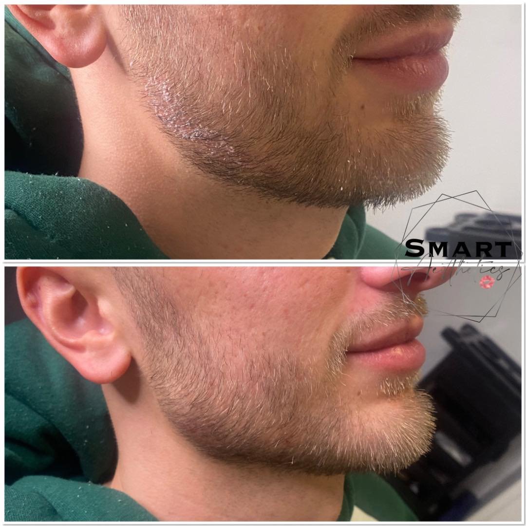 Creating shapes 📐

Male jaw &amp; chin enhancement 👌

Book your treatment today via the link👇🏻 https://www.fresha.com/book-now/smart-aesthetics-gxoik3k4/services?lid=630055&amp;eid=1737977&amp;pId=lol

#jawlinefiller #jawlinecontouring #chinfille