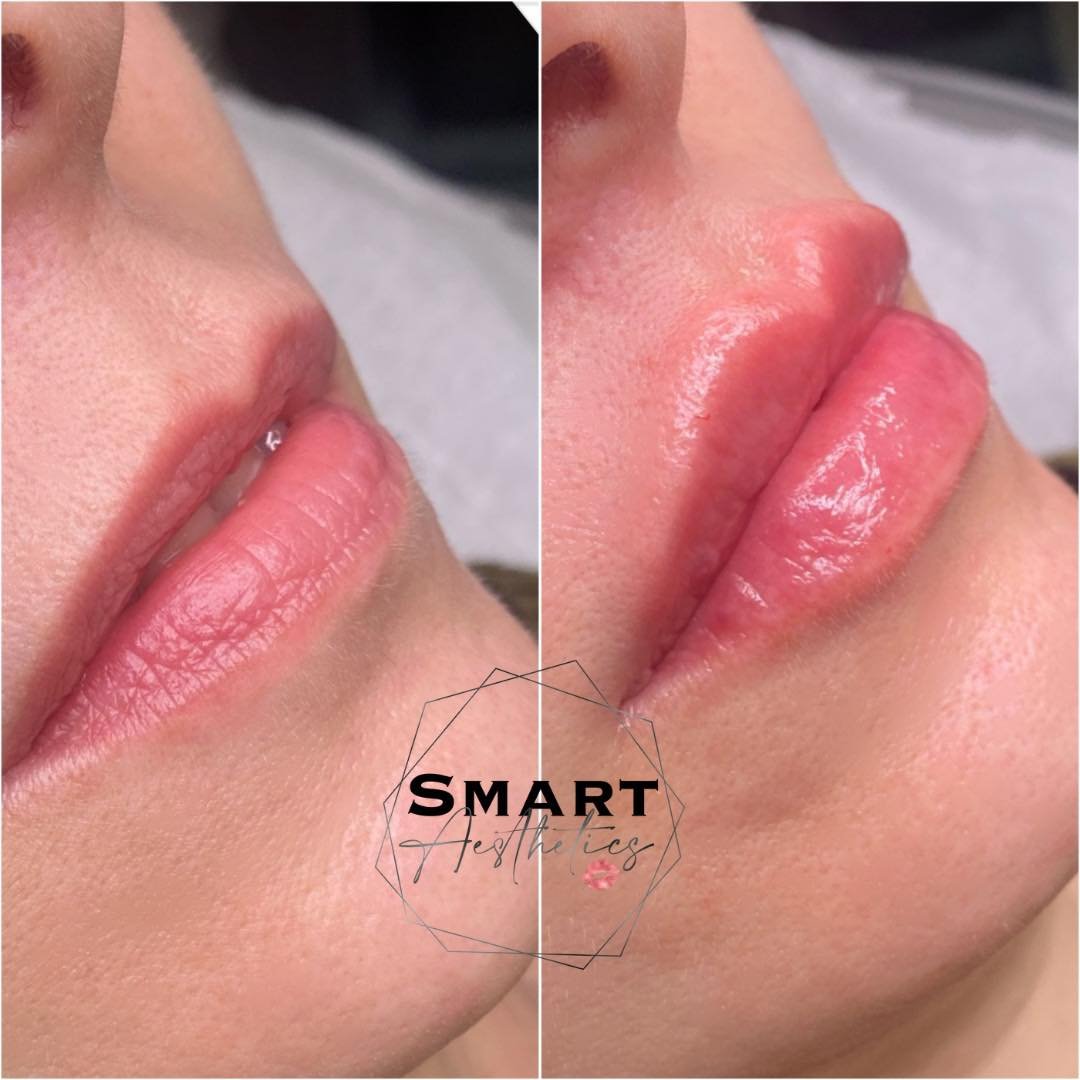 How beautiful are these 😍🔥💋

Book today via the link👇🏻 
https://www.fresha.com/book-now/smart-aesthetics-gxoik3k4/services?lid=630055&amp;eid=1737977&amp;pId=lol

#lipfillertreatment #filler #dermalfiller #dermalfillersbristol #lipinjections #li