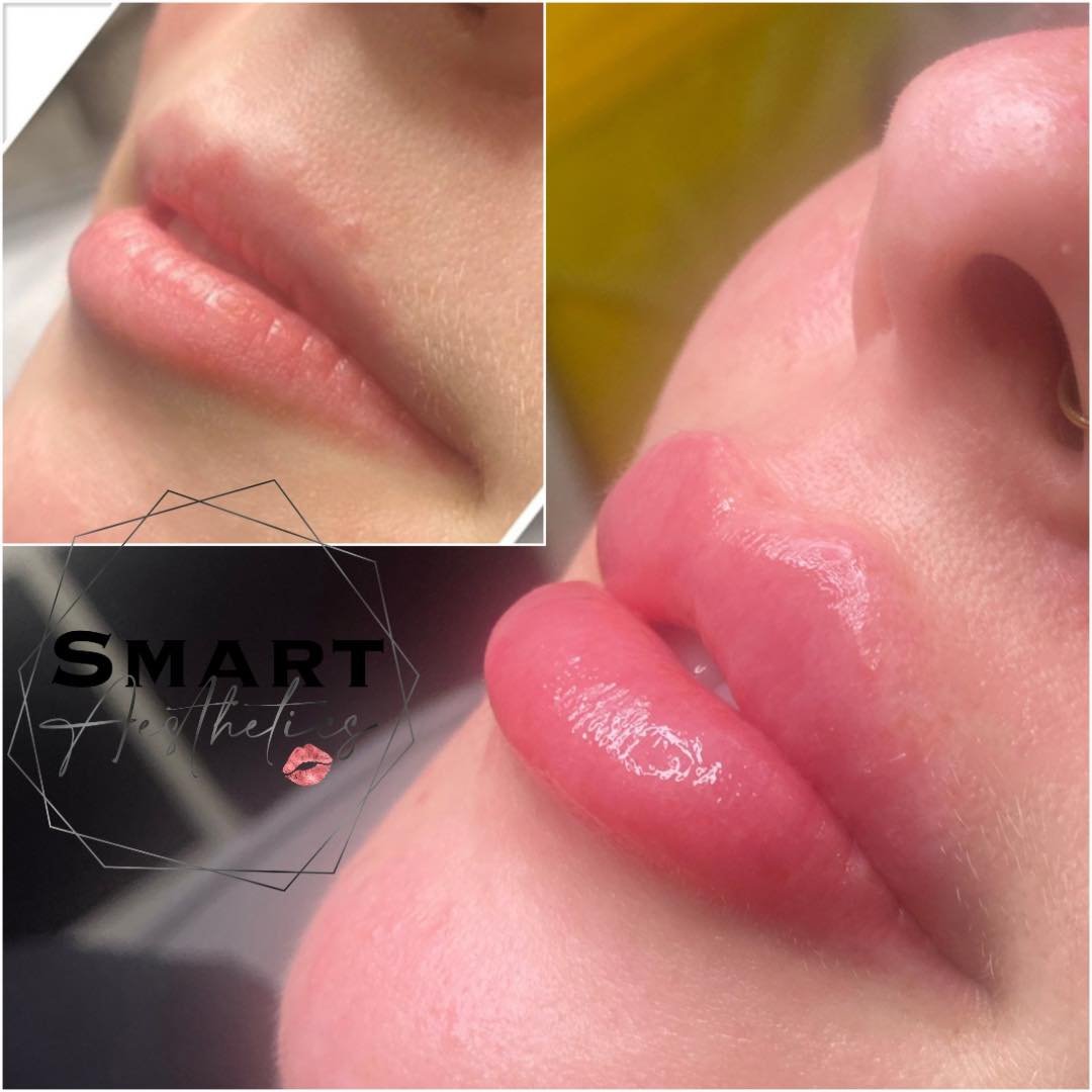 😍 Slow and steady wins the race 🙌

As you can see from the before picture, when this client first started coming to me she didn&rsquo;t have much of a lip border or any shape. Over the past couple of years we have built the lips up slowly, creating