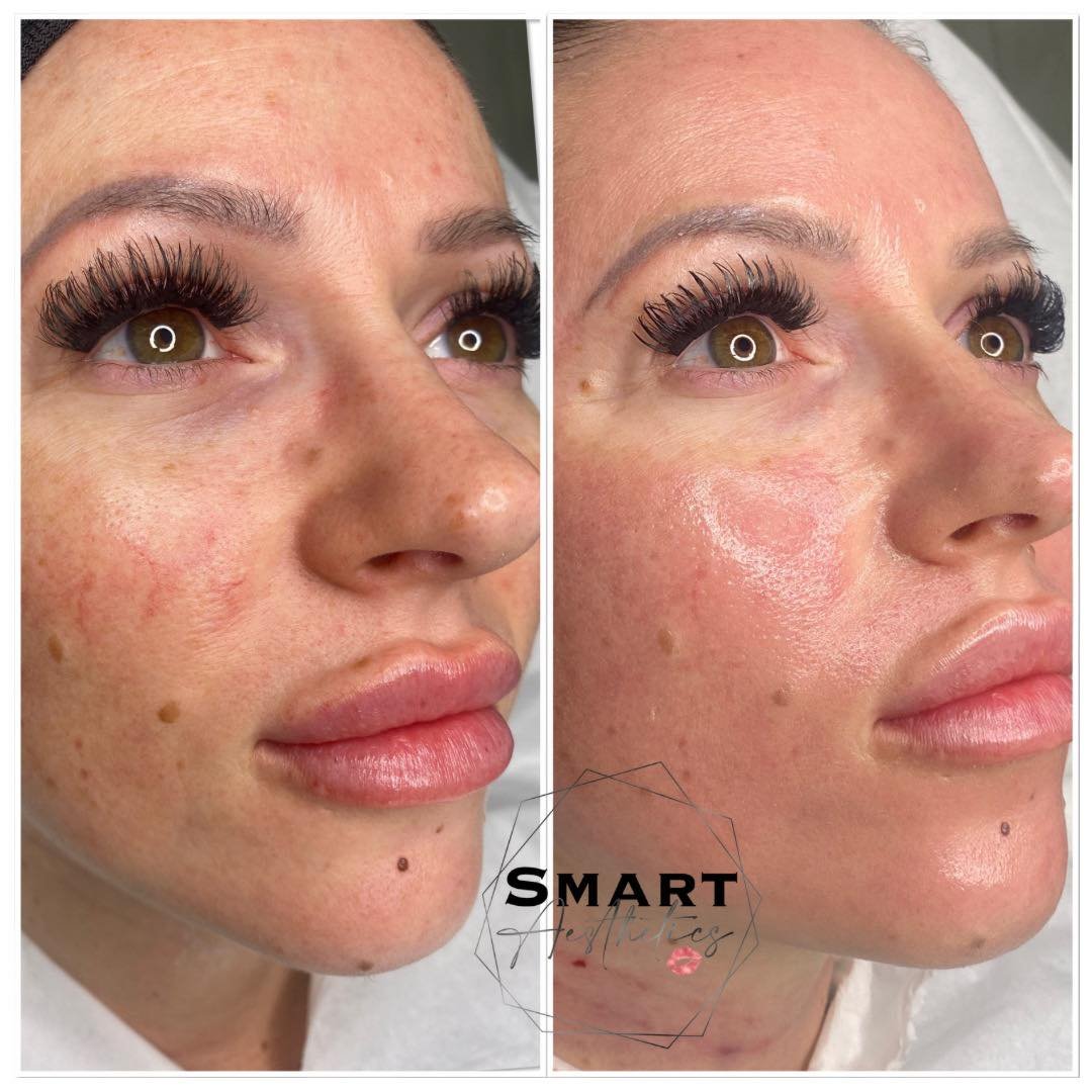 So this is why they call it the GLASS FACIAL 😍

Look at the hydration &amp; smoother glowing skin 🫶🏼

💫What is a glass facial? 💫
This is a high-tech facial treatment where a dose of Botox is diluted with vitamins and infused into the face leavin