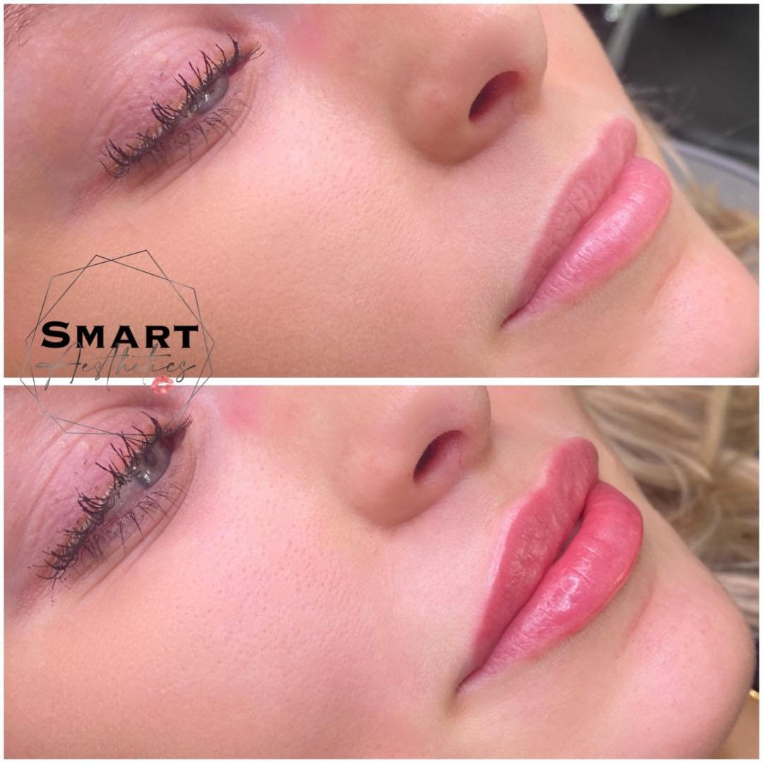 Keeping things natural with a little lift for this beautiful client, 🫶🏼 

Book today 👇🏻
https://www.fresha.com/book-now/smart-aesthetics-gxoik3k4/services?lid=630055&amp;eid=1737977&amp;pId=lol

#lipfillertreatment #filler #dermalfiller #dermalfi