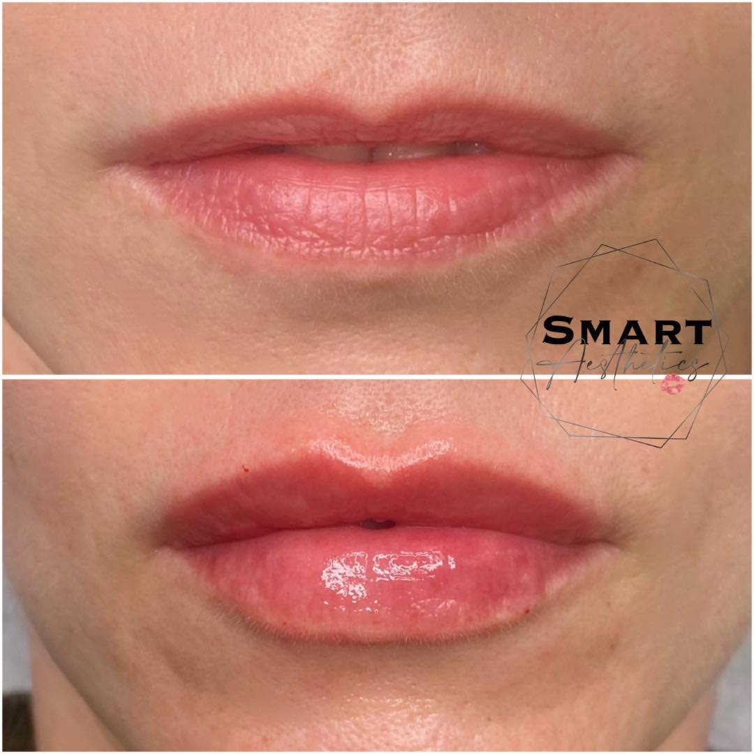 👀 no words needed&hellip; 🔥

Book your treatment today via the link 👇🏻 
https://www.fresha.com/book-now/smart-aesthetics-gxoik3k4/services?lid=630055&amp;eid=1737977&amp;pId=lol

#lipfillertreatment #filler #dermalfiller #dermalfillersbristol #li