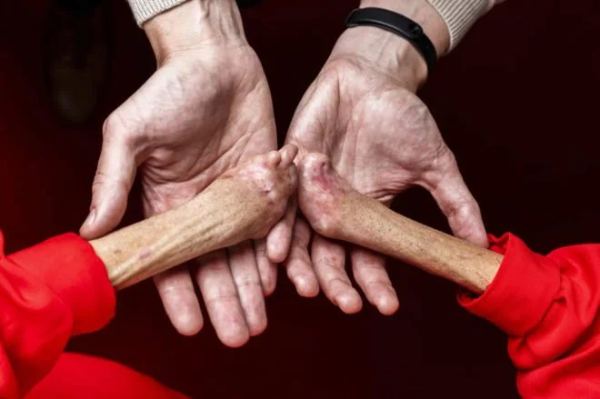 For the First Time, People Living with Congenital Erythropoietic Porphyria Come Together in One Global Space