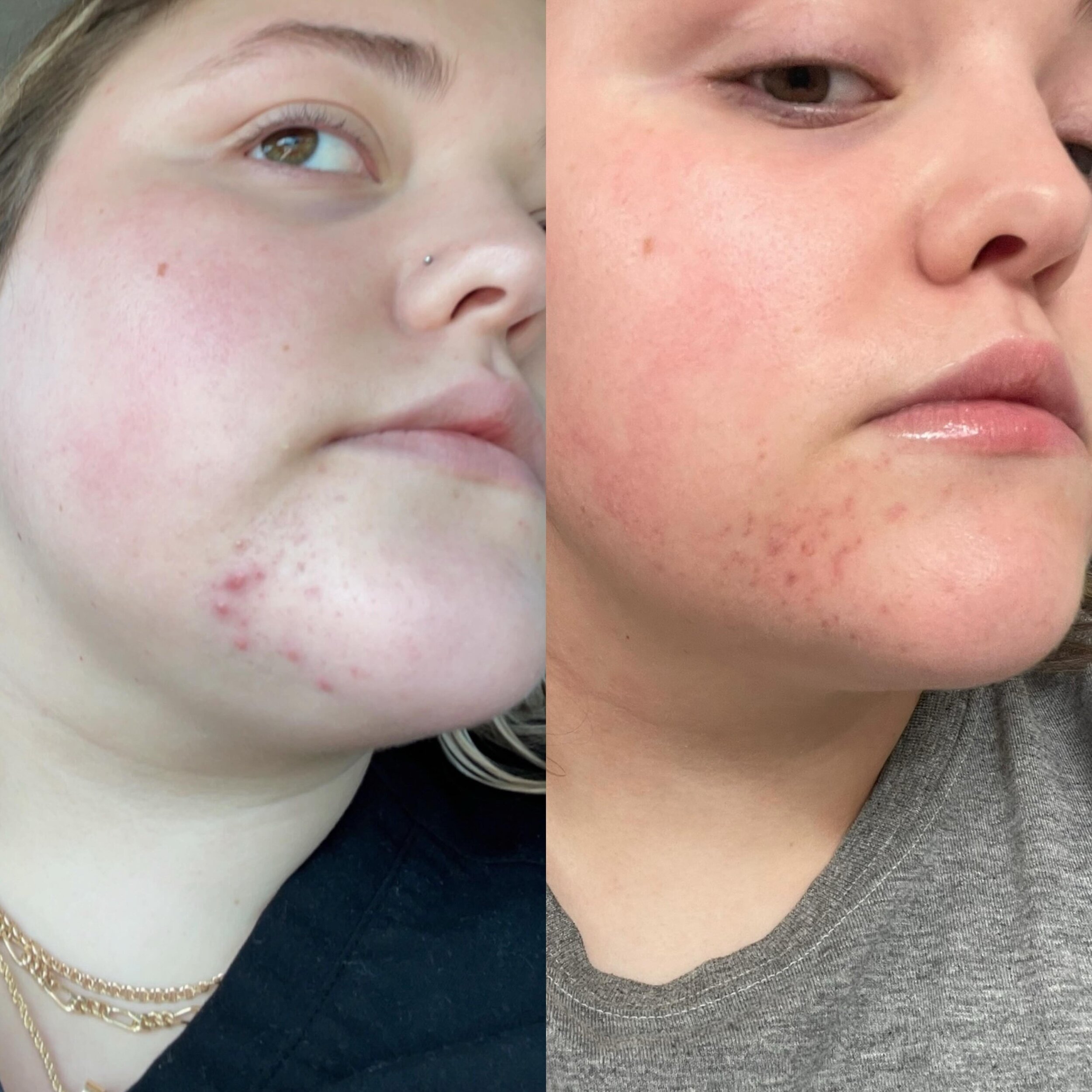 From painful, inflamed acne to PIE and no active breakouts In 2 months ❤️ 

I have struggled with my skin for over a decade now. I get horrible hormonal breakouts and they hurt like a biotch. I&rsquo;m also a picker which is where most of the redness