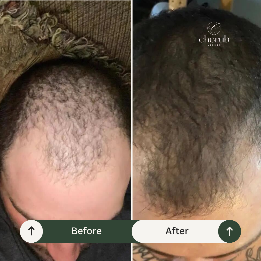 Side-by-side comparison of a person's scalp before and after hair restoration, showing significant increase in hair density after treatment with Cherub London.