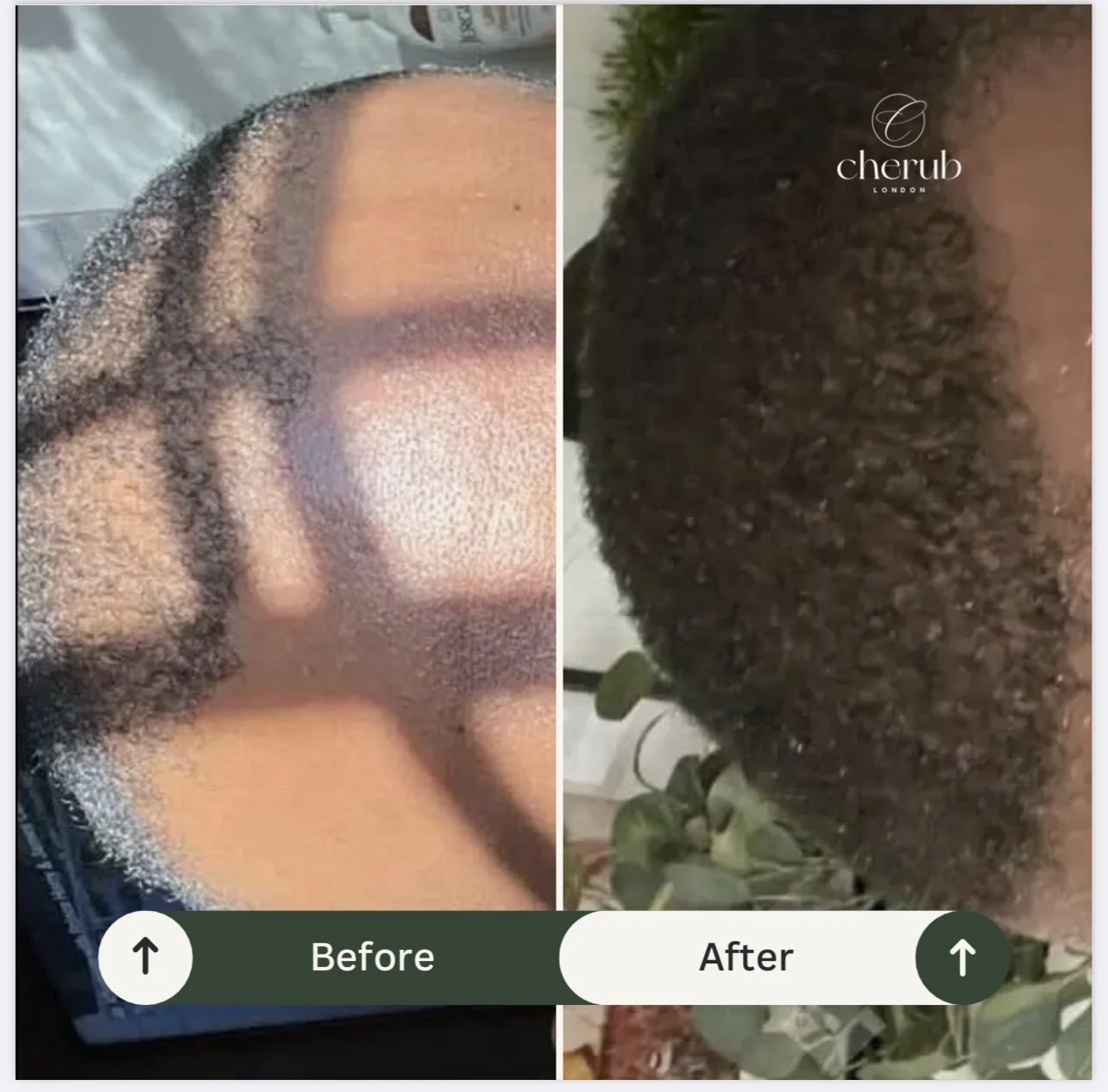 Comparison image showing a person's scalp before and after hair treatment. The left side labeled 'Before' shows a scalp with thin, sparse hair, while the right side labeled 'After' shows a scalp with thick, healthy hair, with a plant visible in the background.