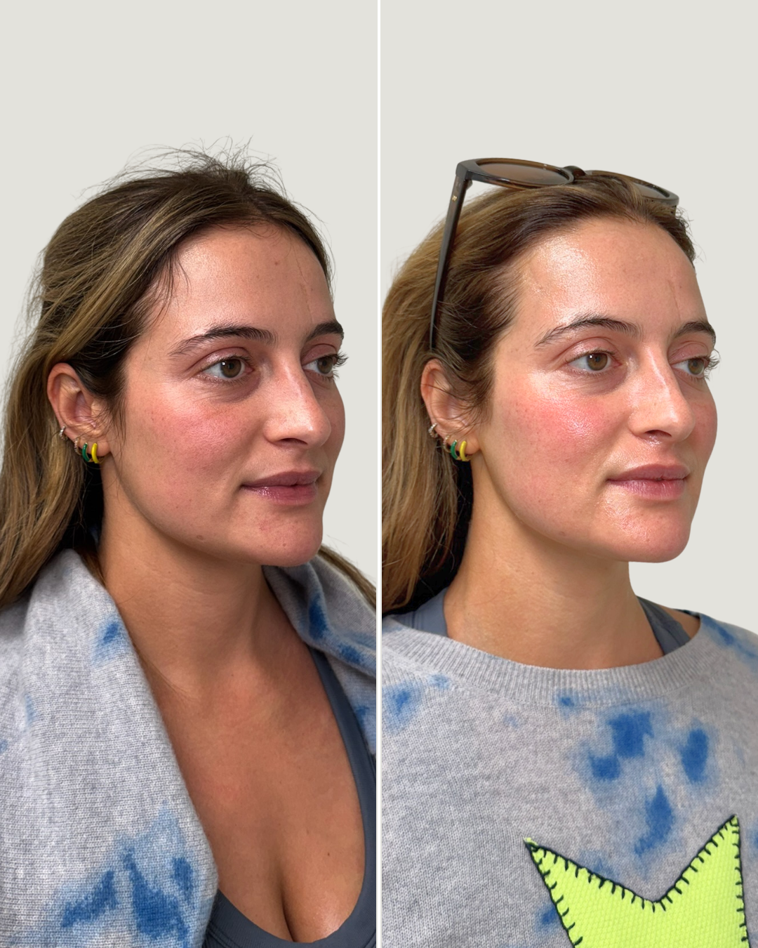 Ansley Facial B&A.png