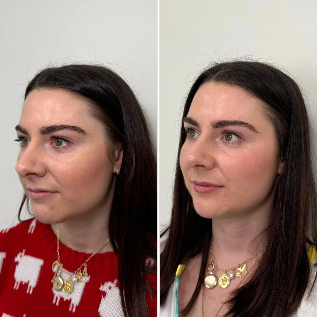 Lip + Chin Filler