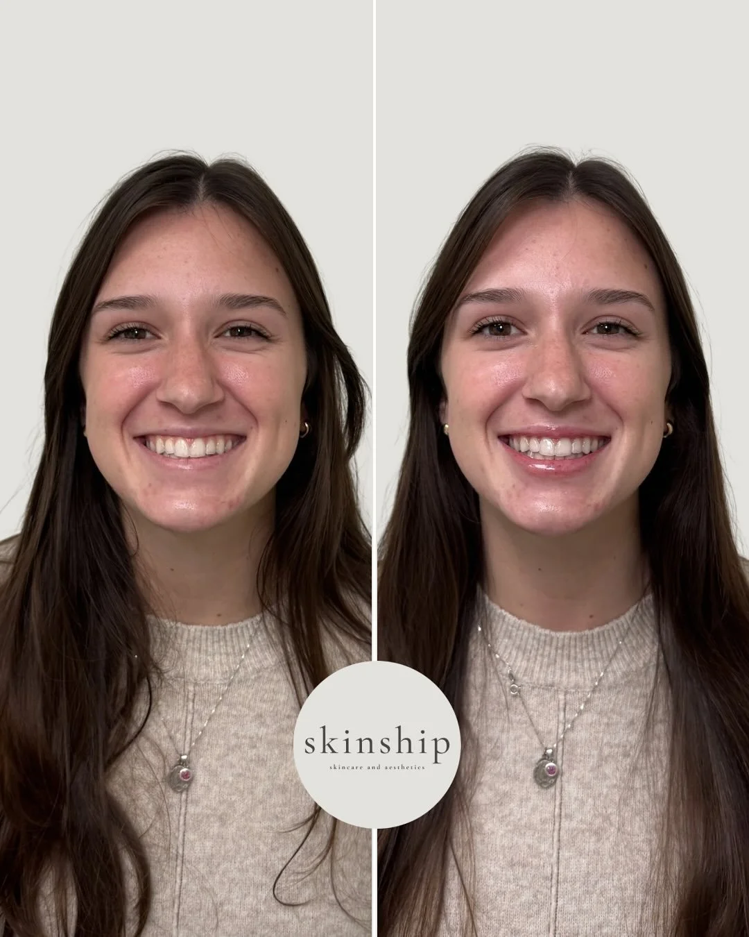 Our Mini Lip - the perfect balance of hydration + structure for a soft, natural result 💧

Book yours at the link in bio or call us at 404-939-7822 to schedule your appointment 🗓️