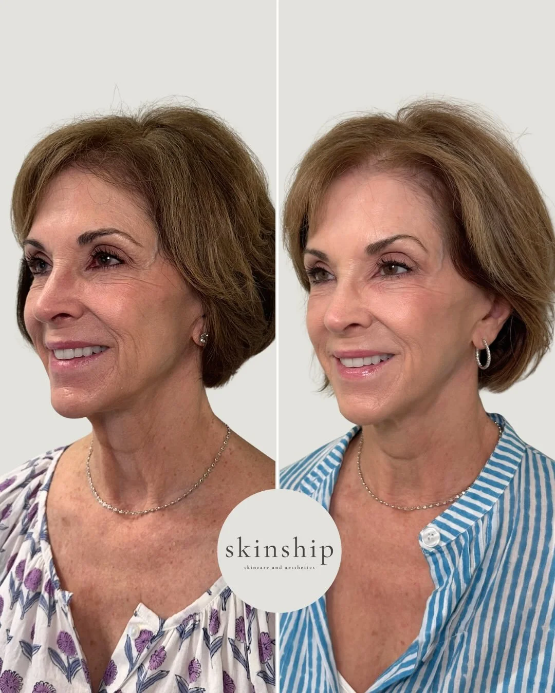 When the patient says “I trust you” 🤝
The best results come from a comprehensive treatment plan. Between these photos we did 2 rounds of full face and neck Dysport, Skinvive, and a microneedling series with exosomes. She looks incredibl