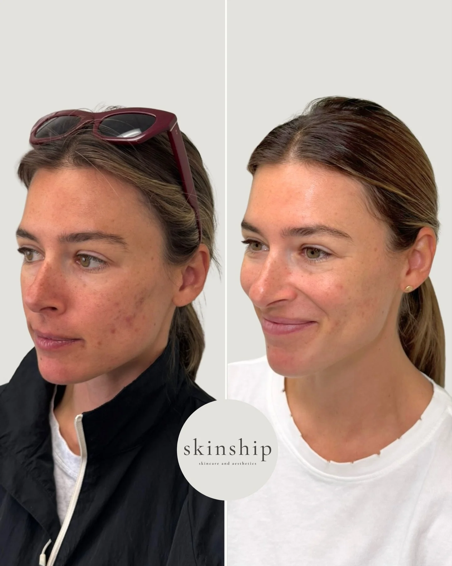 Brighter. Smoother. Clearer ✨

Chemical peels are one of our most-loved treatments for brightening, smoothing texture, calming acne, and fading dark spots. 

What if 2026 was the year of your best skin yet? Jump start your chemical peel series at Ski