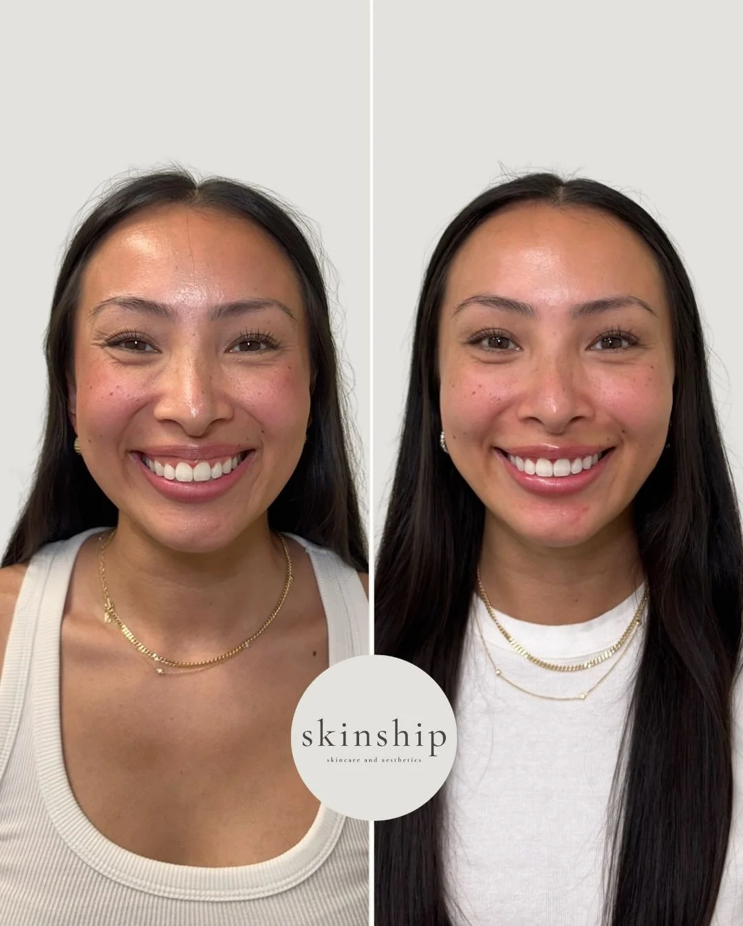 Forehead, frown lines, crow&rsquo;s feet, a subtle brow lift to open the eyes, and a softened gummy smile, all treated by relaxing the muscles that were pulling a little too hard.

The goal isn&rsquo;t frozen&hellip; it&rsquo;s balanced, refreshed, a