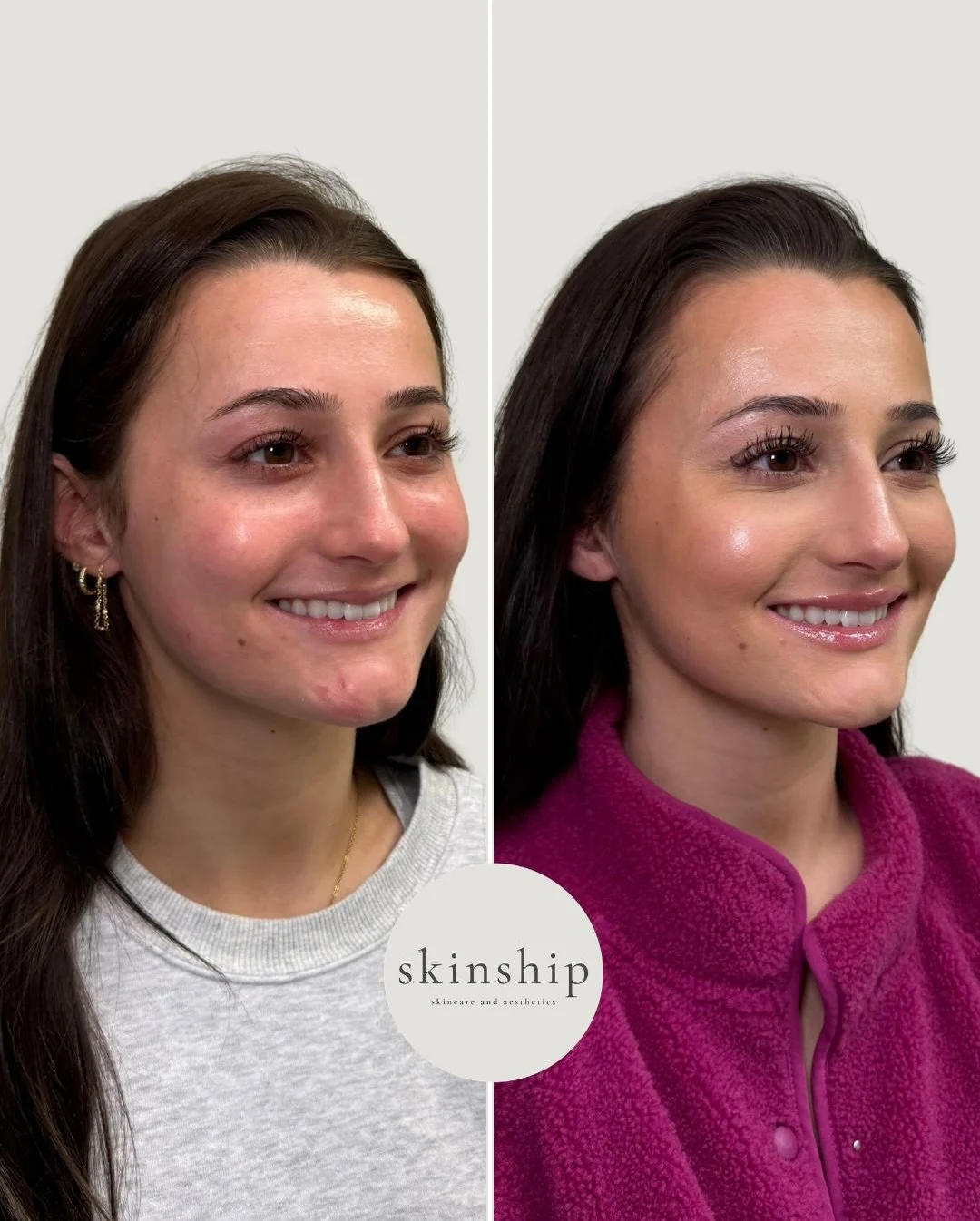 Some recent lips just in time for Valentine&rsquo;s day 💋 
Same lips. Just better.
A subtle enhancement for Valentine&rsquo;s season and beyond.