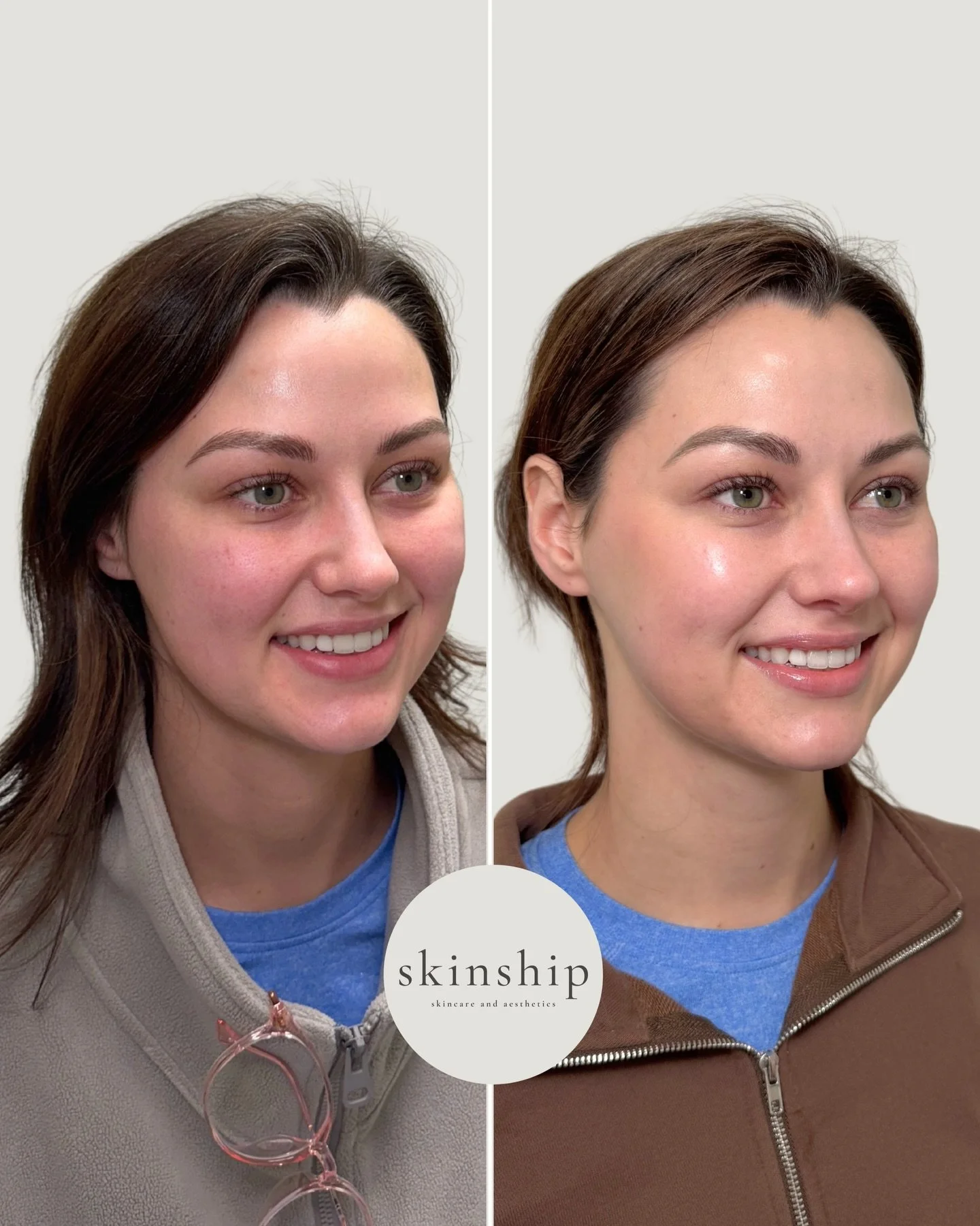 Masseter Botox can be used to both slim the jawline as well as treat TMJ. This treatment helps you achieve a more contoured feminine appearance while relieving jaw tension, reducing headaches, and improving facial symmetry. 

Save this post and ask y