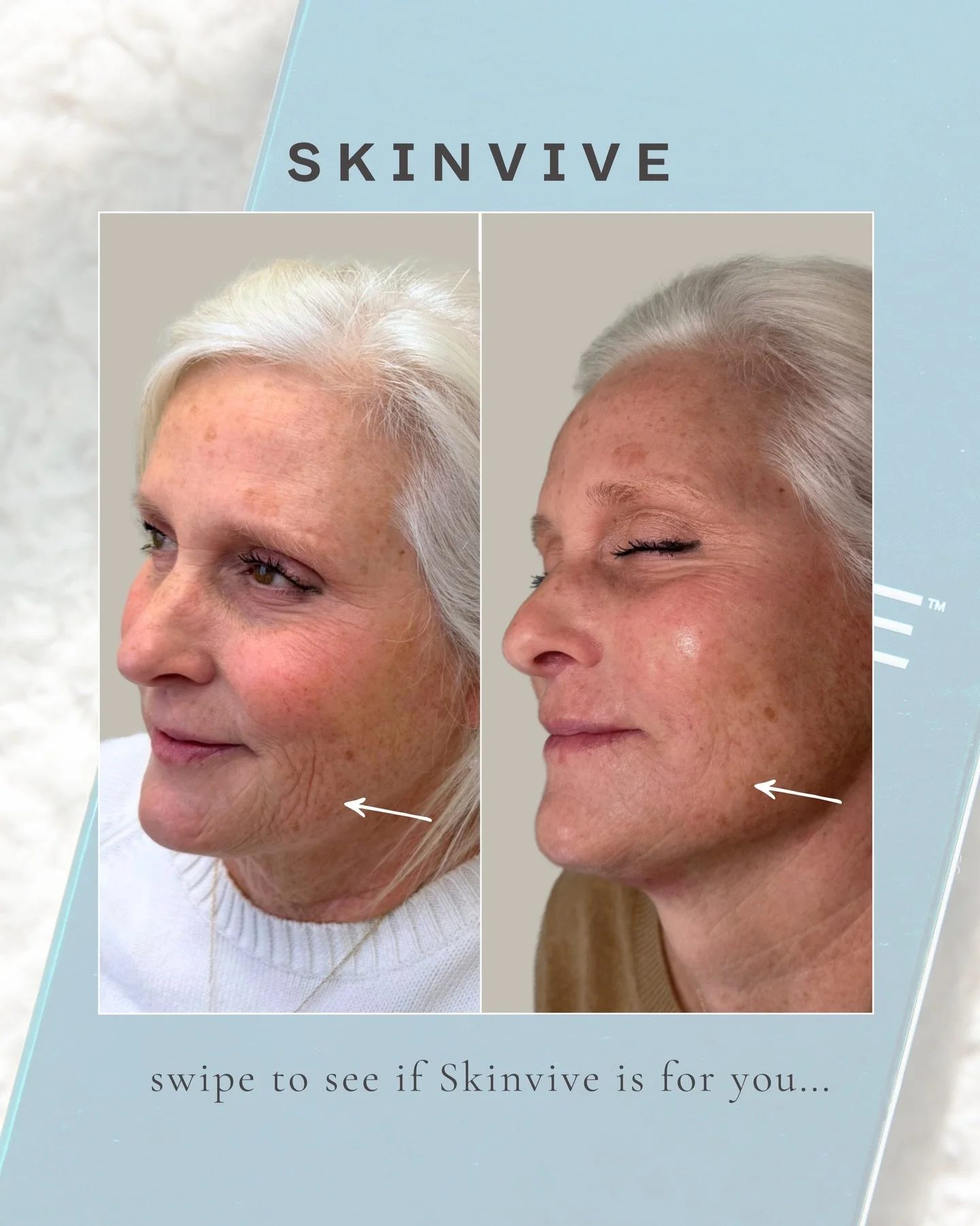 If you want your skin to look smoother, glowier, and just&hellip; better, Skinvive is one of our favorite skin boosters for hydrated, refined, healthy skin &mdash; without adding volume.

And when used intentionally? Chef&rsquo;s kiss.

If you&rsquo;
