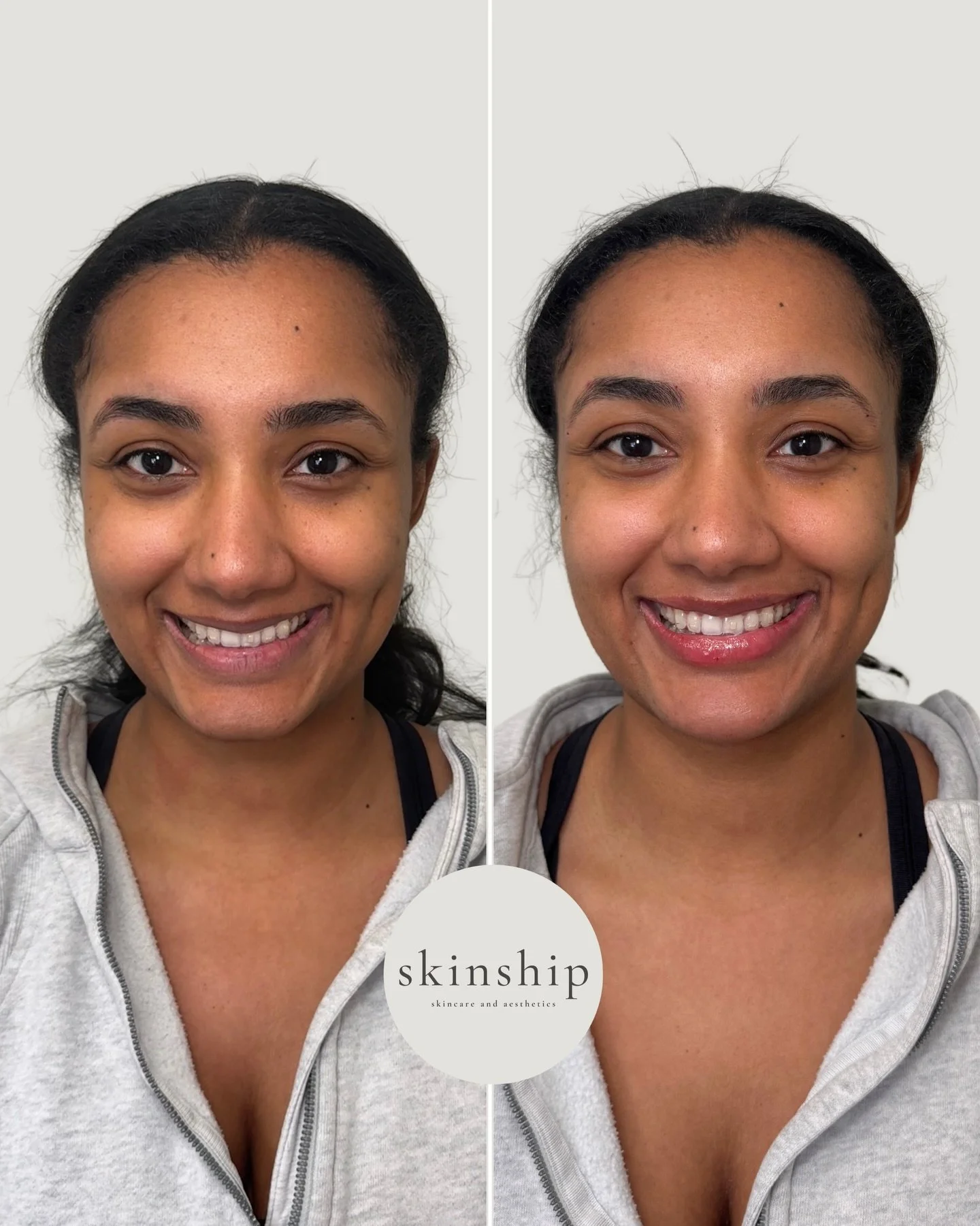A little volume. A little projection. A lot of balance. 

This bride combined lip filler and chin filler for the perfect balance of softness and contour and is officially wedding ready!
