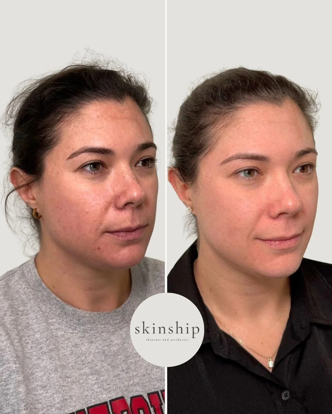 Consistency is key.

These results were achieved with a series of chemical peels and a customized medical-grade skincare routine including topical prescriptions. Professional treatments + the right products at home make all the difference.