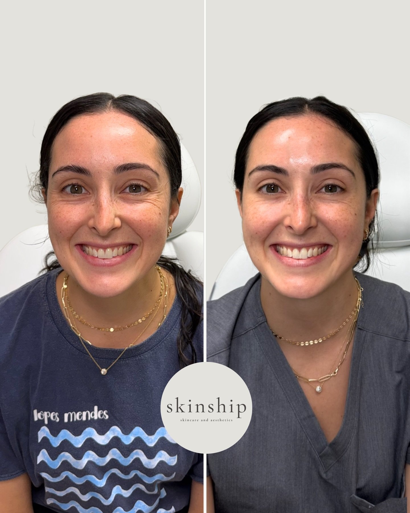 Smooth where it matters, expressive where it counts. ✨

Botox doesn&rsquo;t have to change your face. It can soften lines, while still preserving your natural expression.
 
Book your appointment at Skinship and let&rsquo;s create results that still f