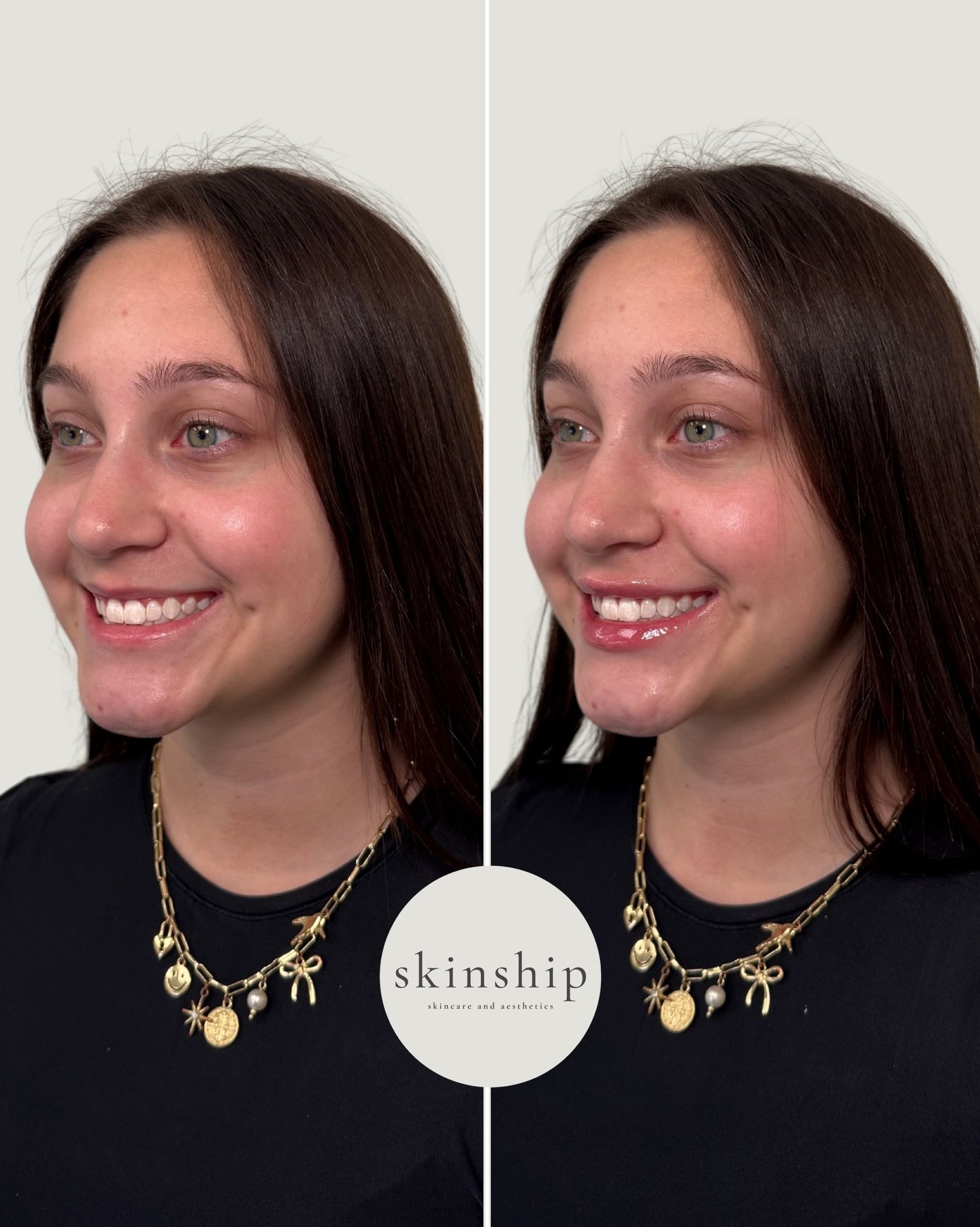 Lip filler can enhance shape, add hydration, and bring back soft volume &mdash; all while keeping everything proportionate.

Tap the link in bio to book your appointment at Skinship. 💉