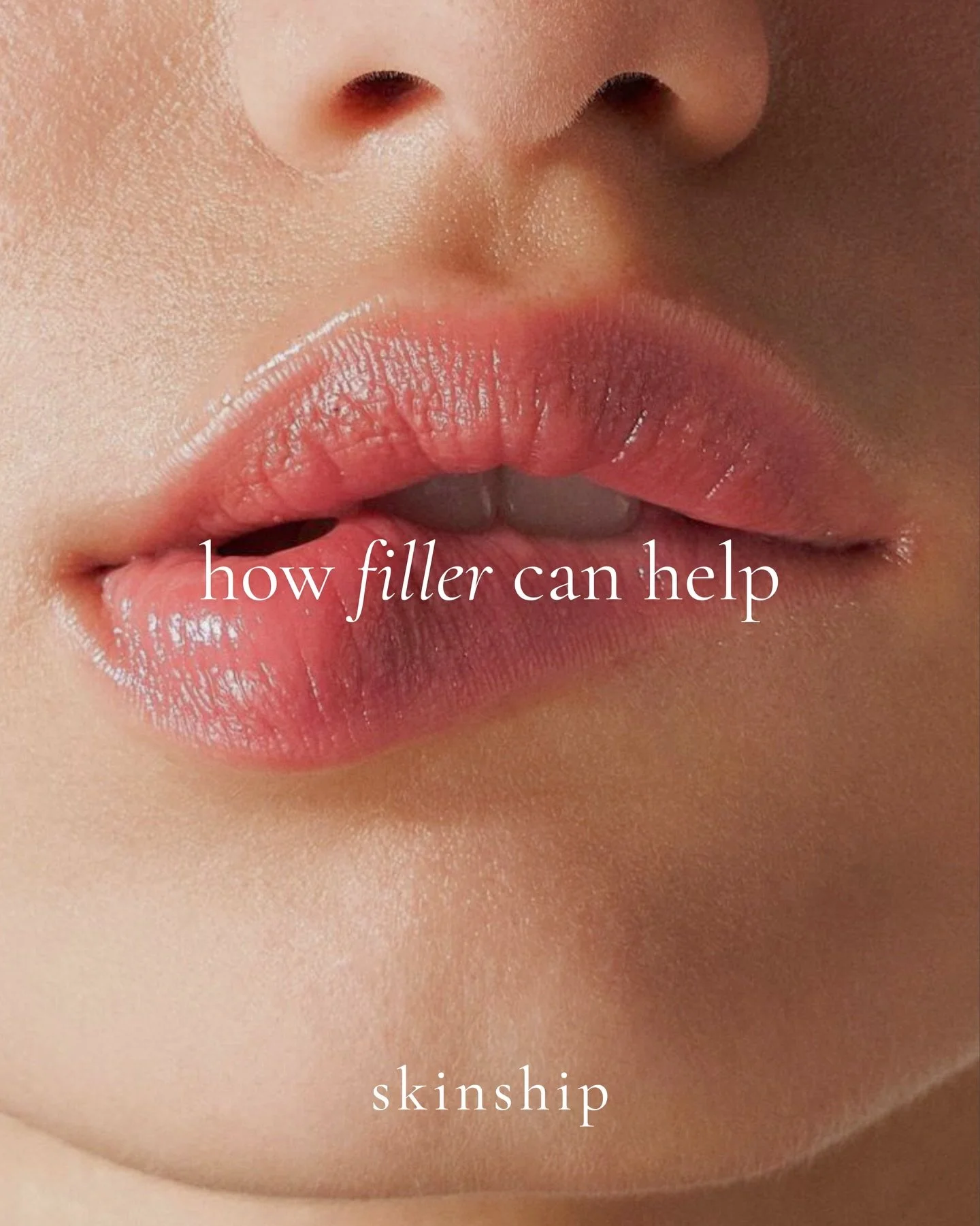 Aesthetics is an art and knowing how muscles, gravity, and aging affect the face is critical to perfecting the artwork. 

With filler and other injectables we often treat one area to impact another. Here are some common complaints and how filler can 