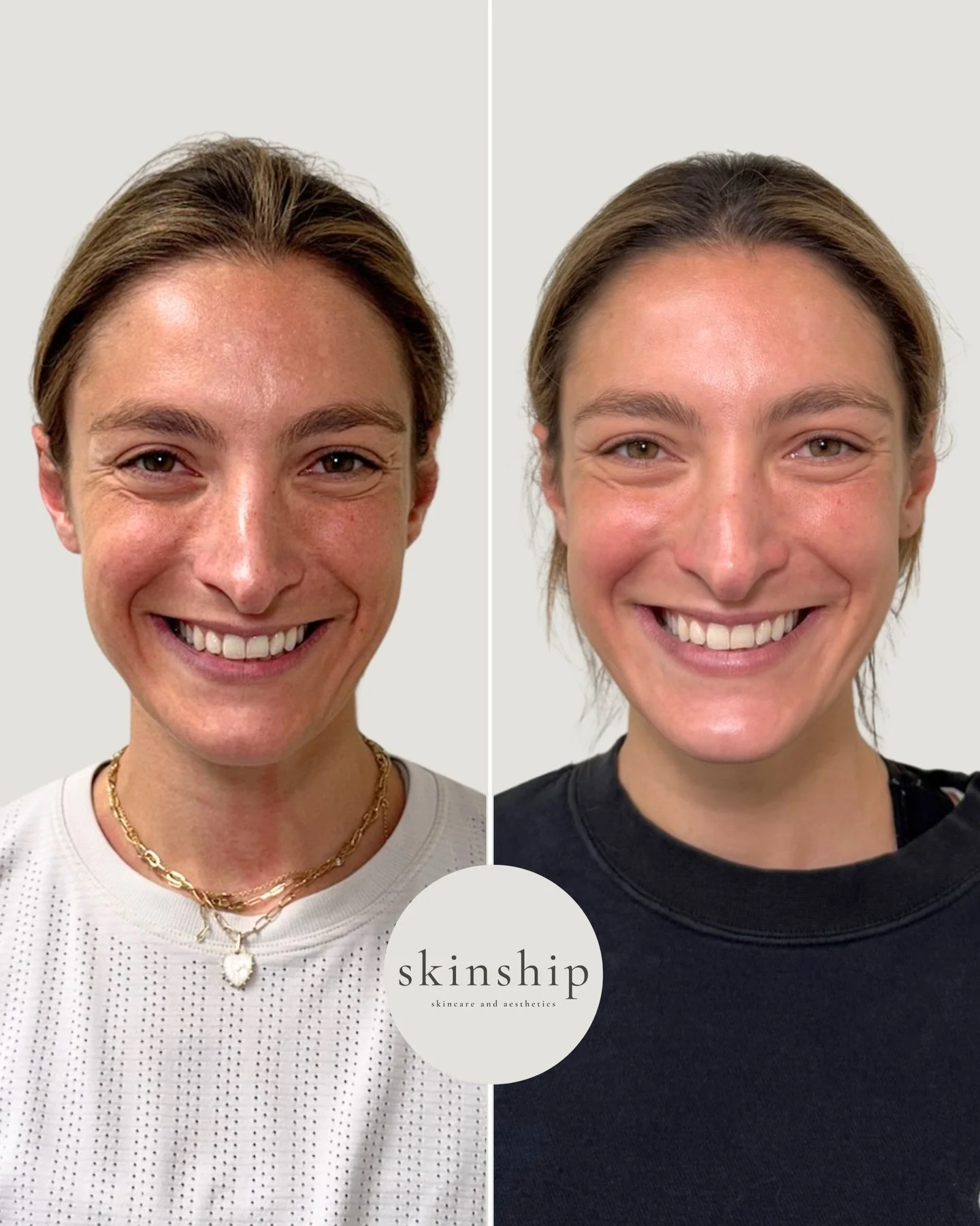 What changes when you focus on skin quality: 

✨More even tone, smoother texture, refined pigmentation, and softer lines. 

Built through microneedling with exosomes and consistent, skincare paired with prescriptions. Not just one thing &mdash; a pla