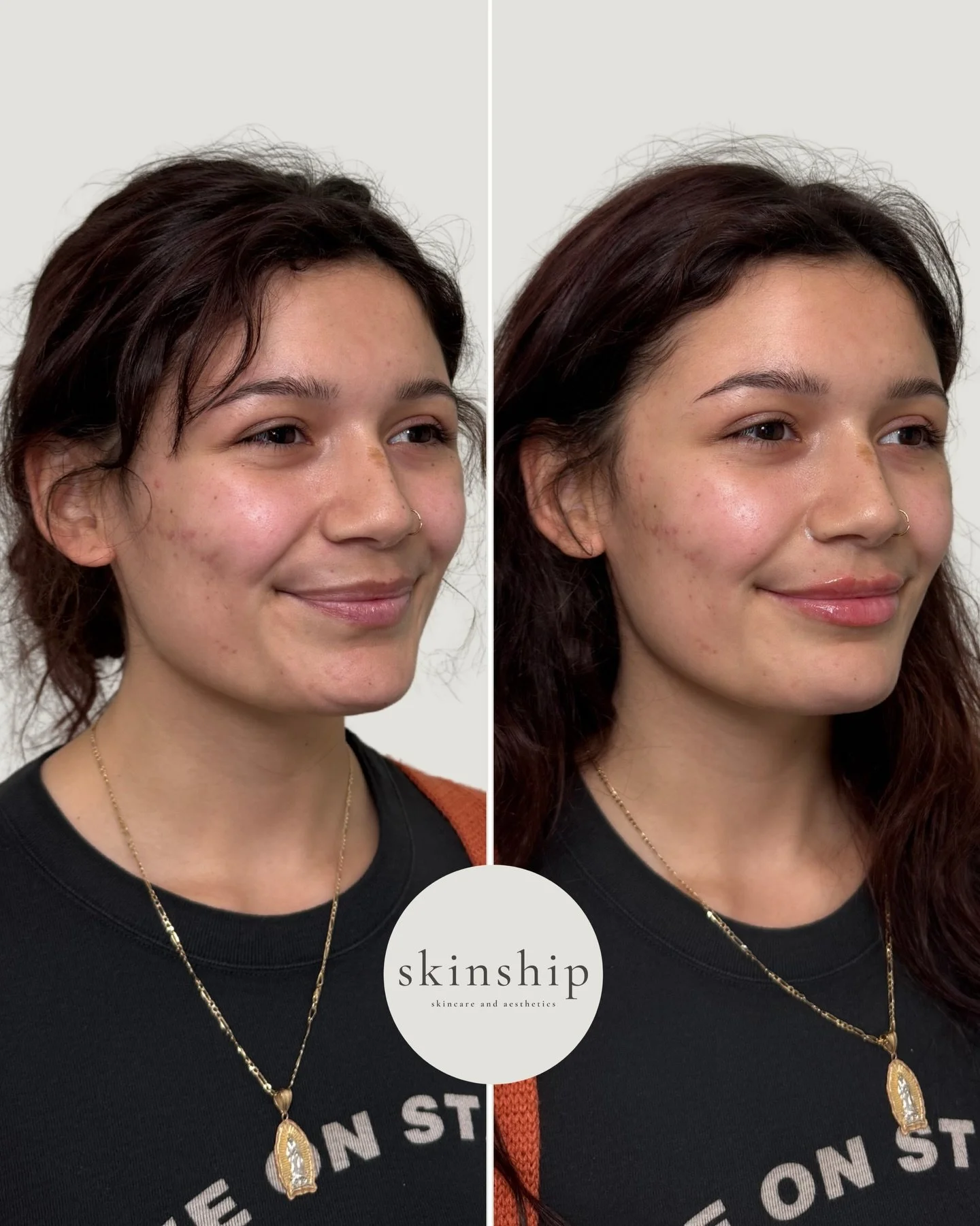 A little volume, a little hydration, a little balance ⚖️

Subtle lip filler enhances your natural shape, improves symmetry, and keeps you looking like you

The goal is never &ldquo;overdone.&rdquo; The right treatment plan is intentional, tailored, a