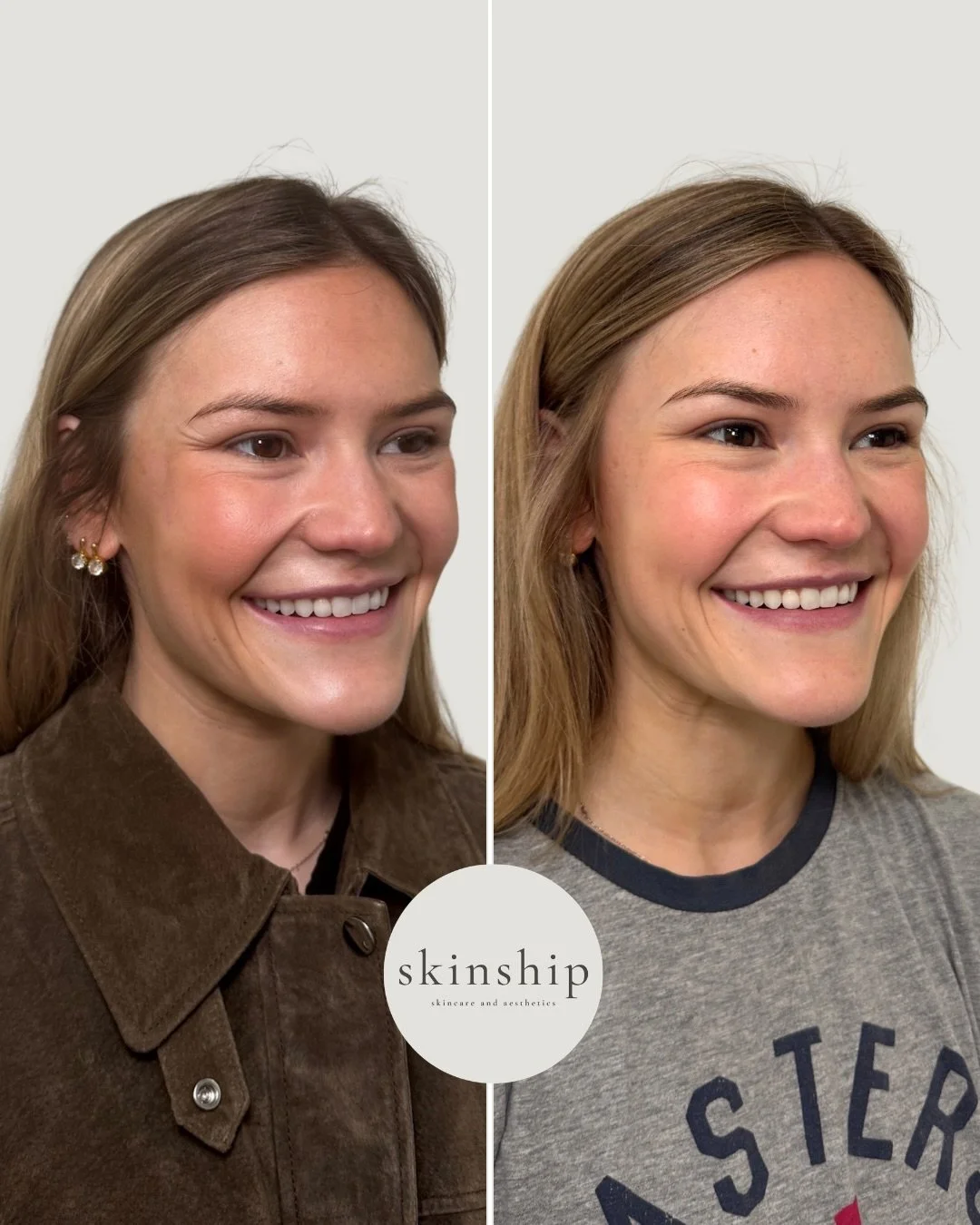 Botox and Dysport treatments are not not one size fits all. With an individualized approach, we can smooth fine lines and dynamic wrinkles while maintaining natural facial movement for subtle, never overdone results 🤍