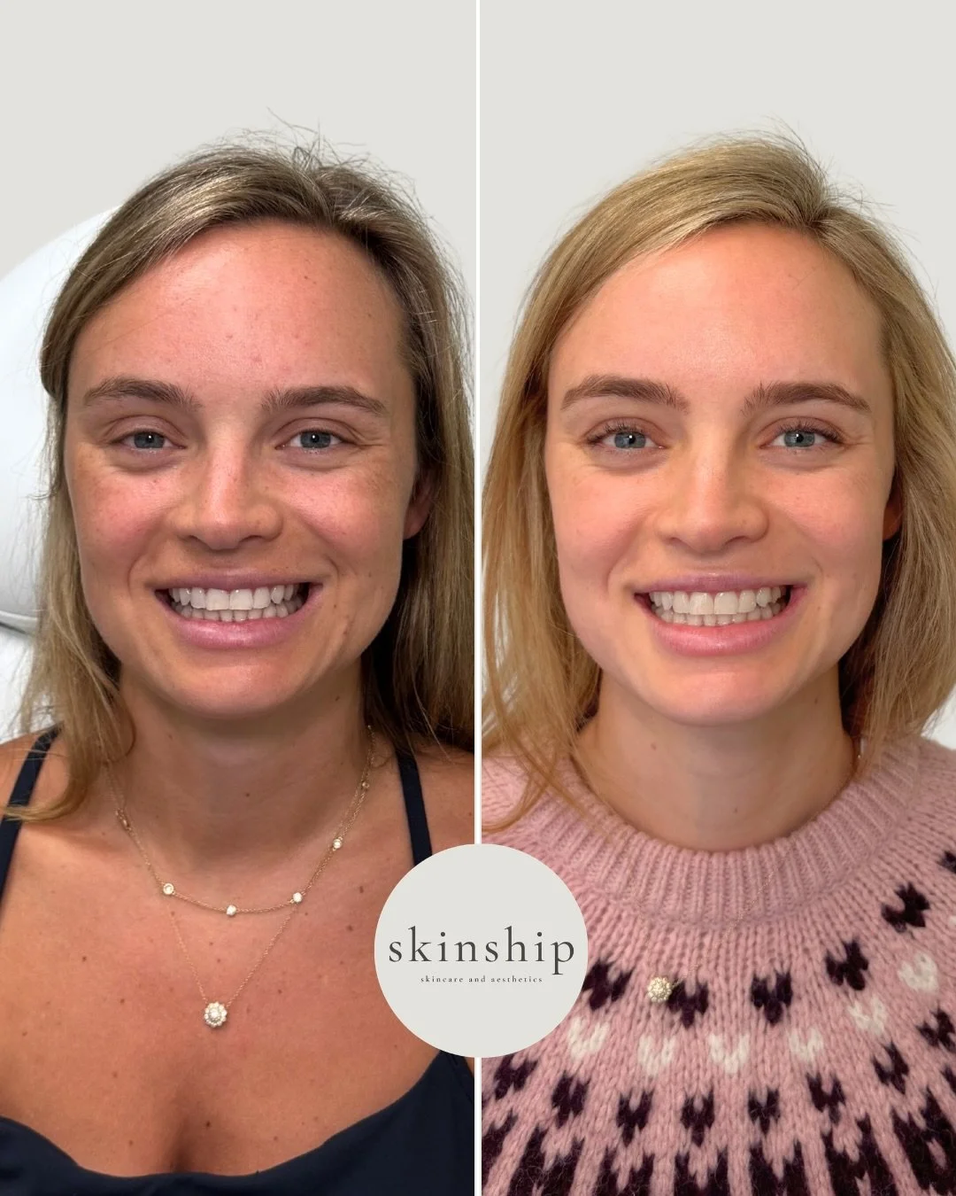 Not one treatment&mdash;a strategic plan.

Our bridal packages are built on customized treatment plans, layering different modalities over time to improve tone, texture, and overall skin health. Every plan is individualized, because your best skin sh