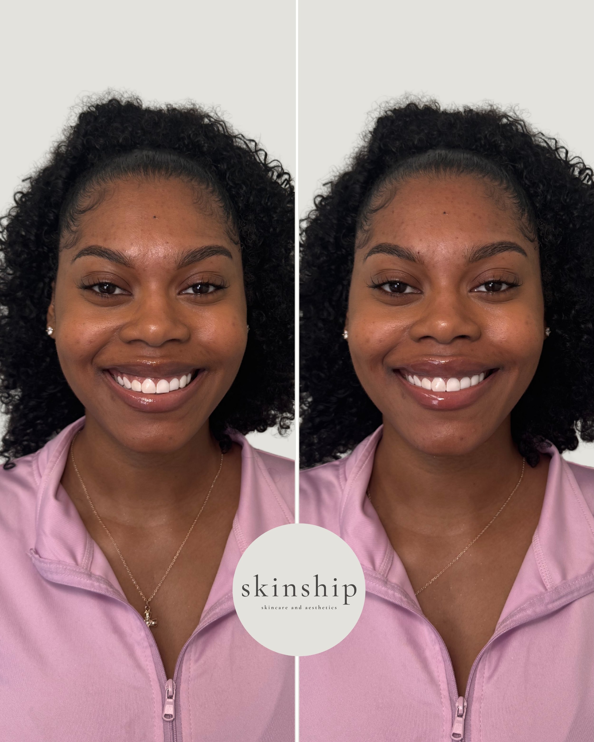 Same lips&hellip; just a lot happier about them 😄

Added volume &amp; balanced the top lip for a softer, fuller smile &mdash; and clearly she couldn&rsquo;t help but show it off in the after.

#atlantafiller #atlantamedspa #lipfillerbeforeandafter #