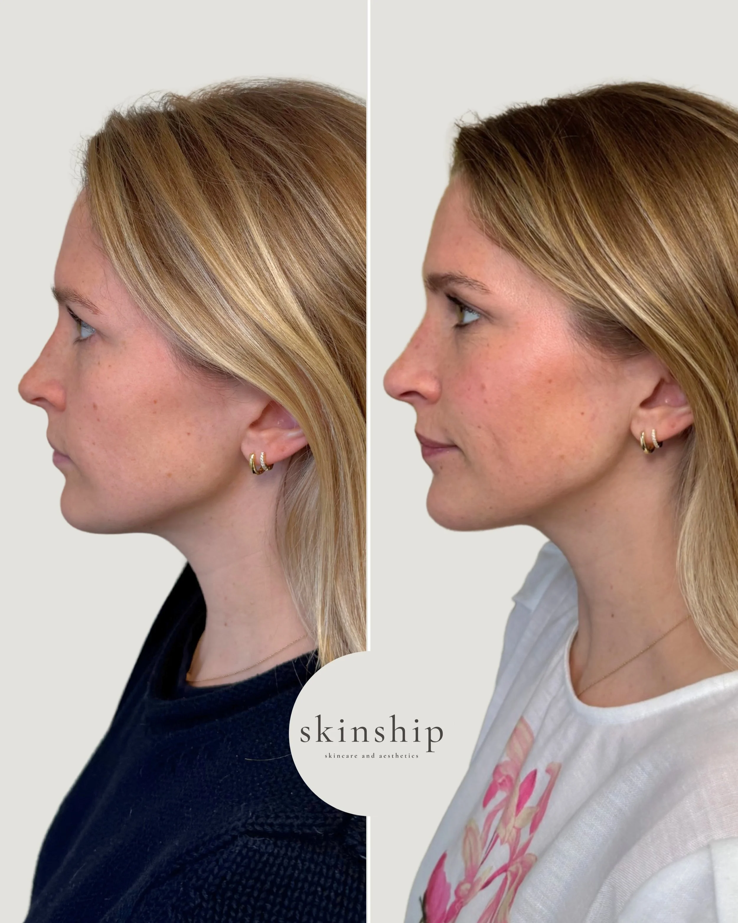 Subtle lift, sculpting, and collagen support while still looking completely like herself 📐

Sculptra helps restore structure gradually for a more defined chin and jawline, tighter-looking skin, soft volume restoration, and a well-rested glow ✨

#bef