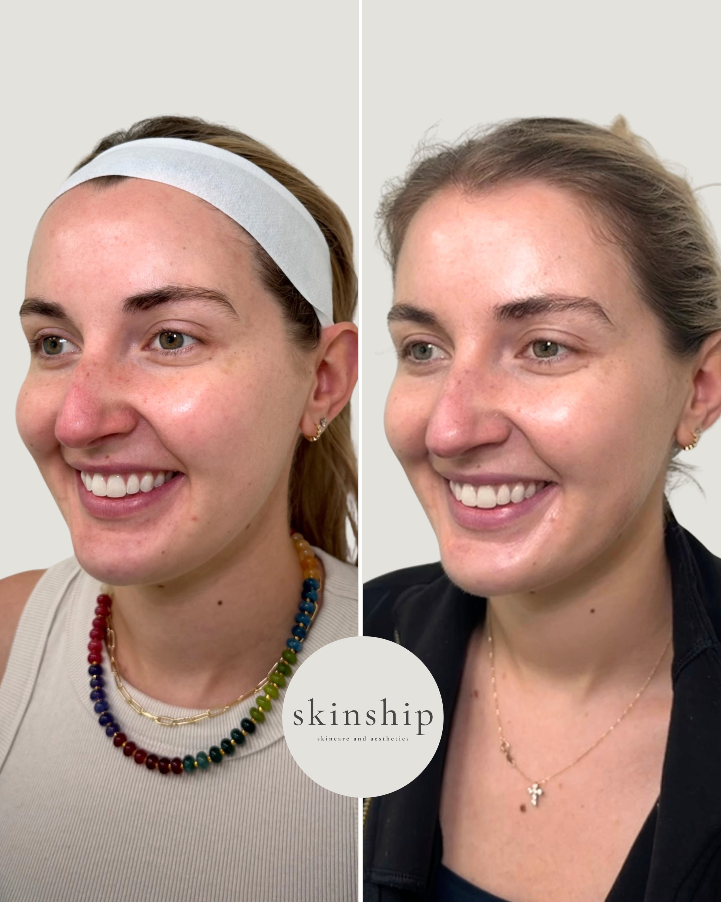 After just one chemical peel treatment, our patient saw improvement in redness, post-acne hyperpigmentation, and overall skin tone and texture.

Proof that small treatments can make a big difference. Can&rsquo;t wait to complete her series!

#Chemica