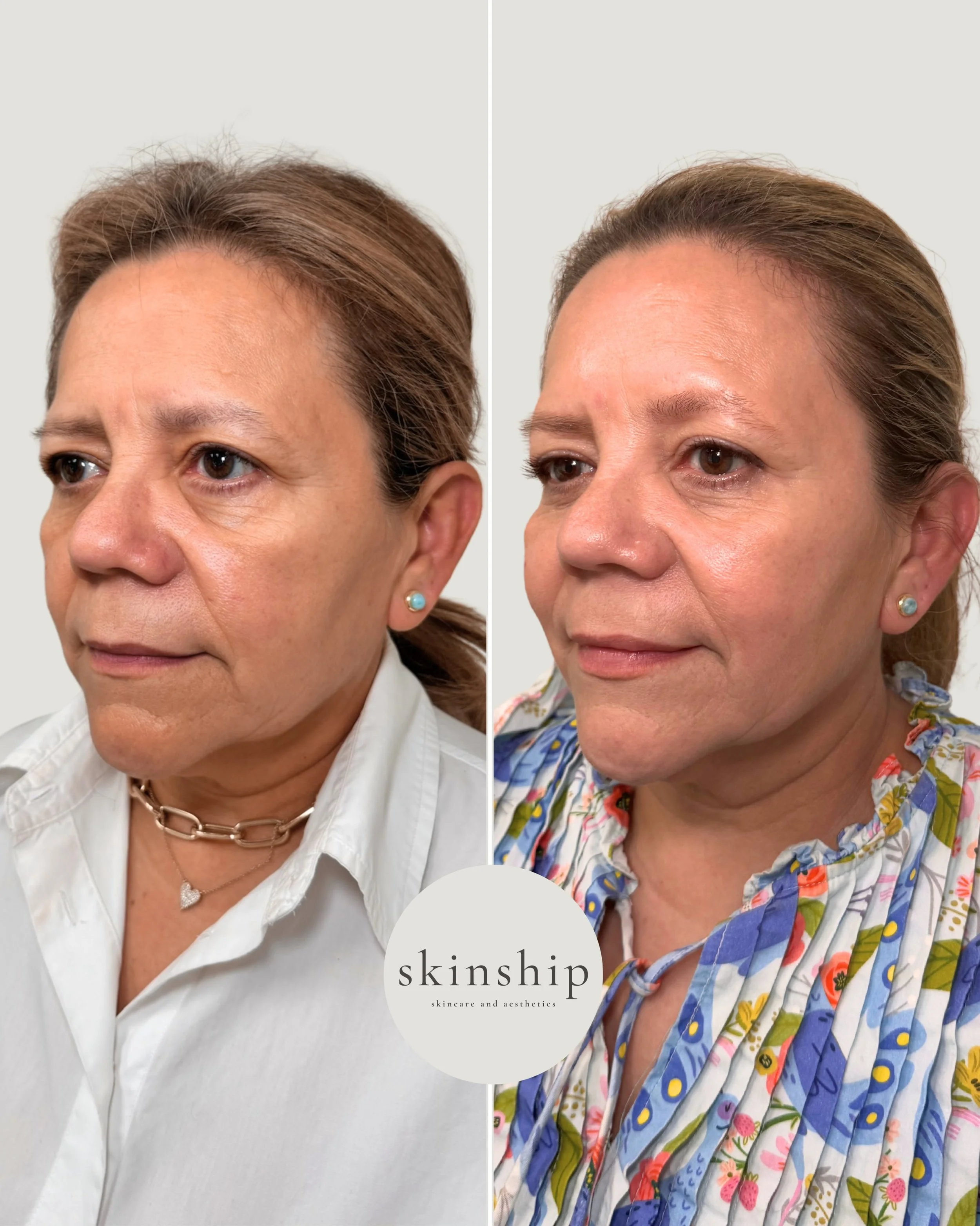 This is what facial balancing is all about.✨

Using a multimodality approach, @kaylawalker_pa strategically treated areas of the face with neurotoxins and HA fillers to add support and balance! The goal is always to create a more refreshed version of