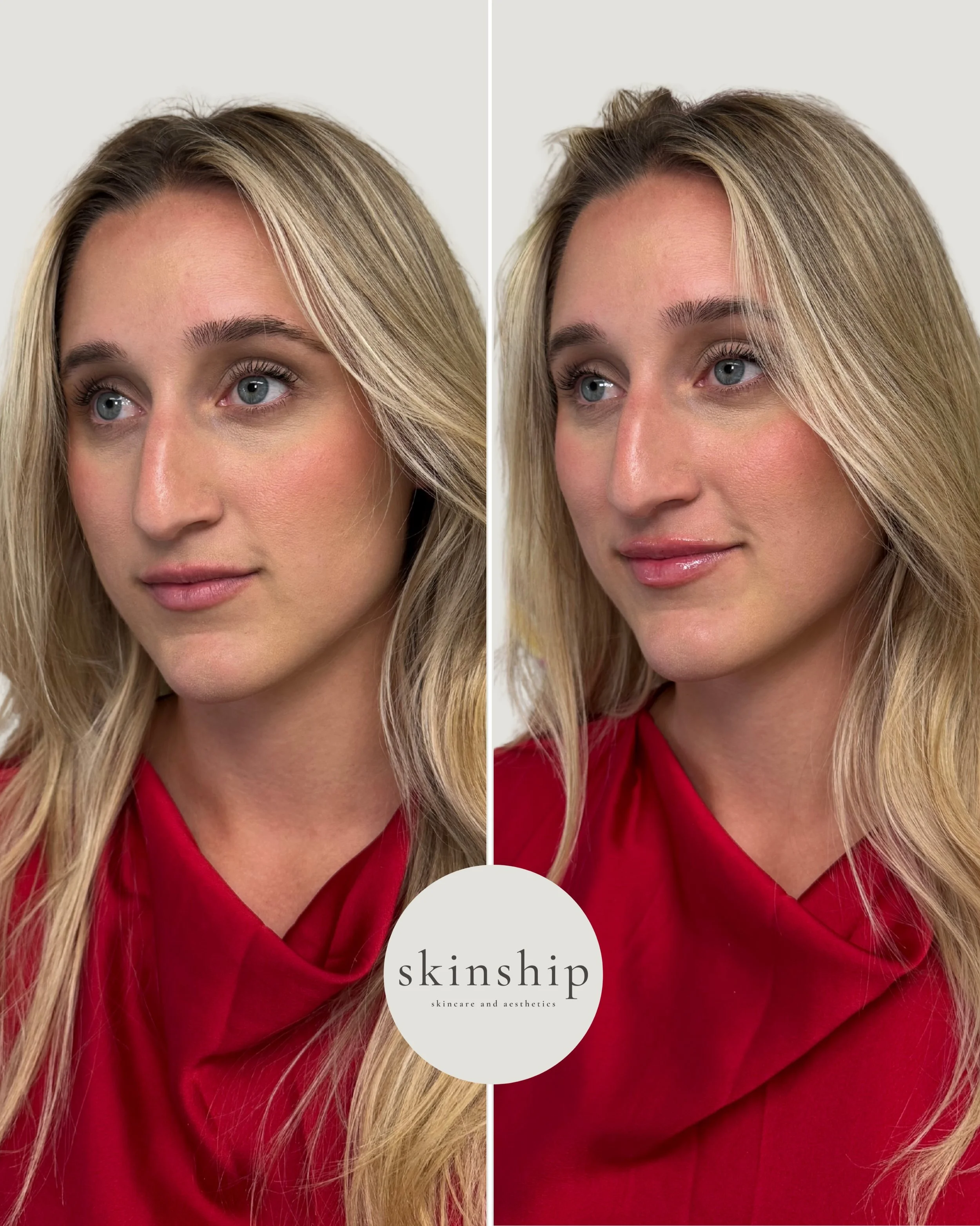 Natural-looking lips never go out of style 💋