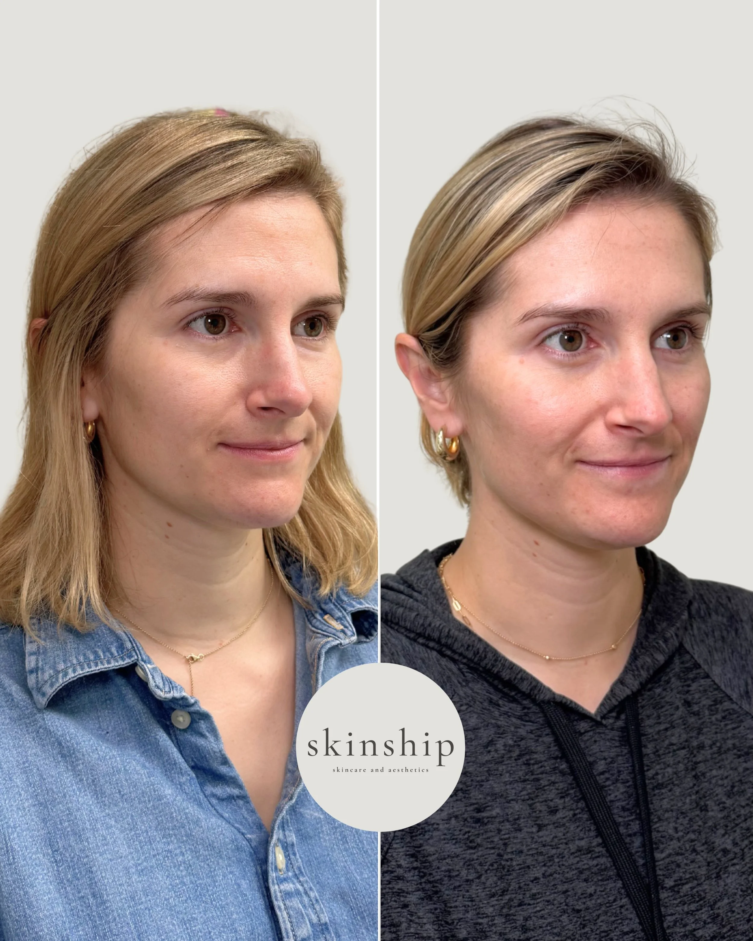 We used a combination of Botox and microneedling with PRP to give this patient a boost in skin quality and treat both fine lines and dynamic wrinkles. Fluctuating hormones during pregnancy and postpartum can take a toll on our skin and these are two 