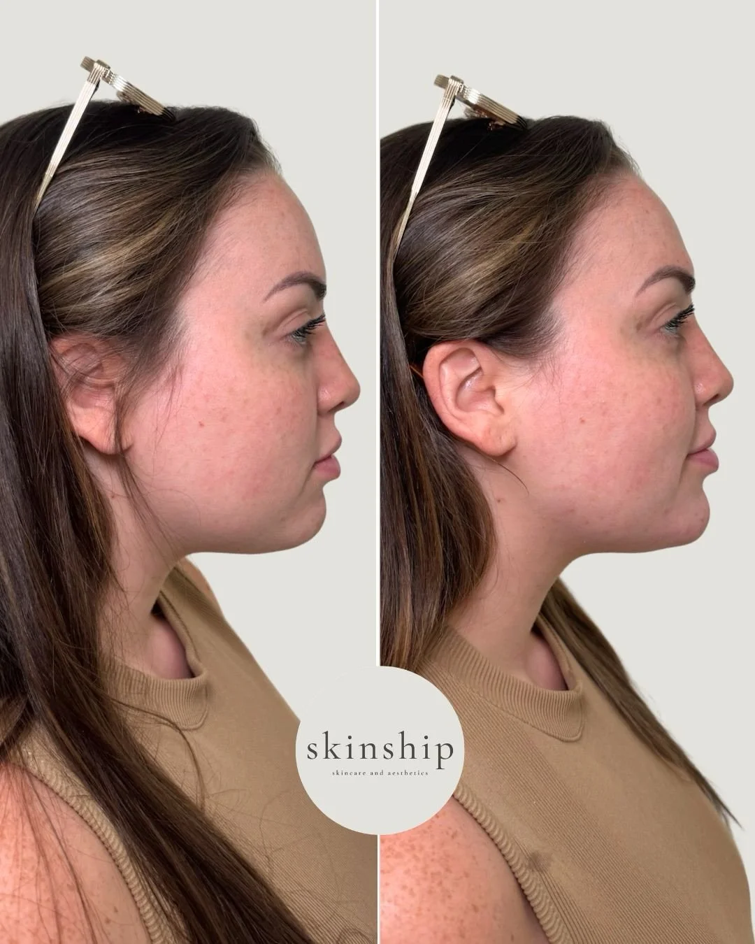 Chin filler is one of our favorite treatments to elongate the face and improve our profile. This treatment is also crucial to facial balancing and ensuring that our lips and lower face are proportional to the upper two thirds of the face. 

Intereste
