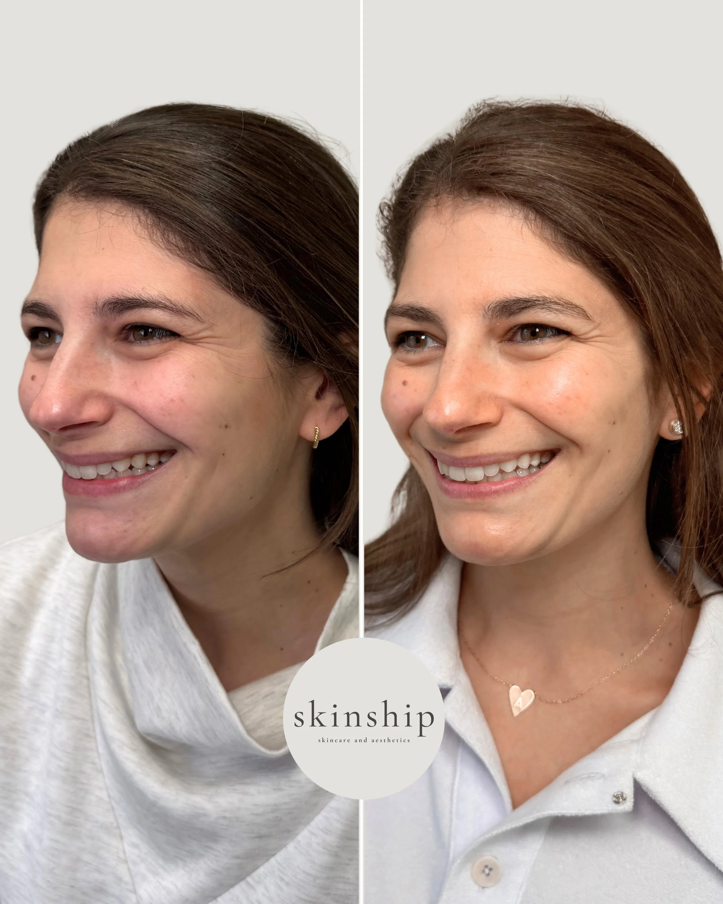 Wedding planning is about more than just the venue, guestlist, and the dress.

Our Skinship Signature Facial is the perfect no-downtime skin prep for a healthy, radiant glow on your wedding day, plus all the exciting events along the way - think enga