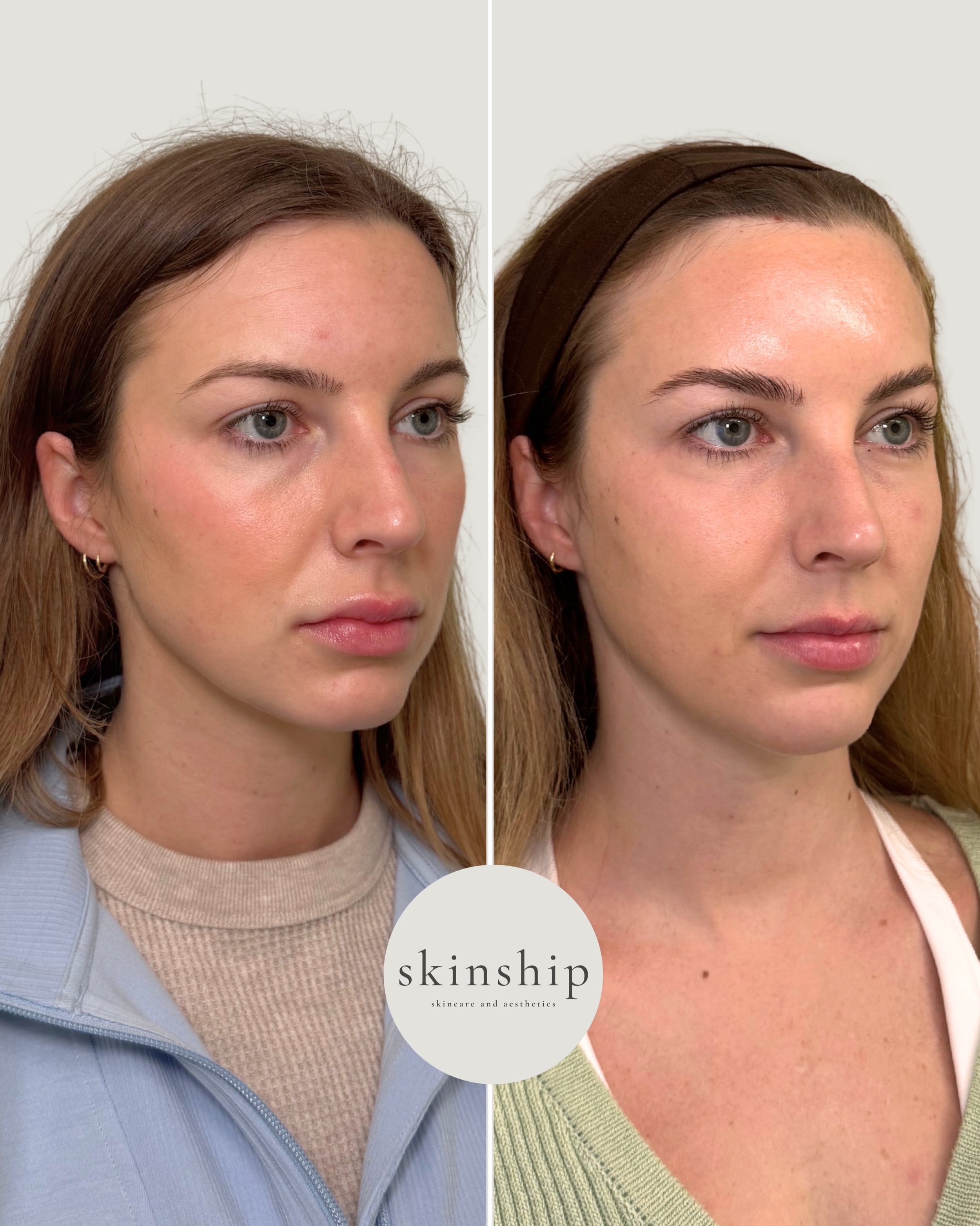 What if we told you the right treatment plan can actually make you look more natural and more like yourself?

For this transformation, we took a comprehensive approach:
 &bull; Lip dissolve + a refreshed, natural lip enhancement
 &bull; Neuromodulato