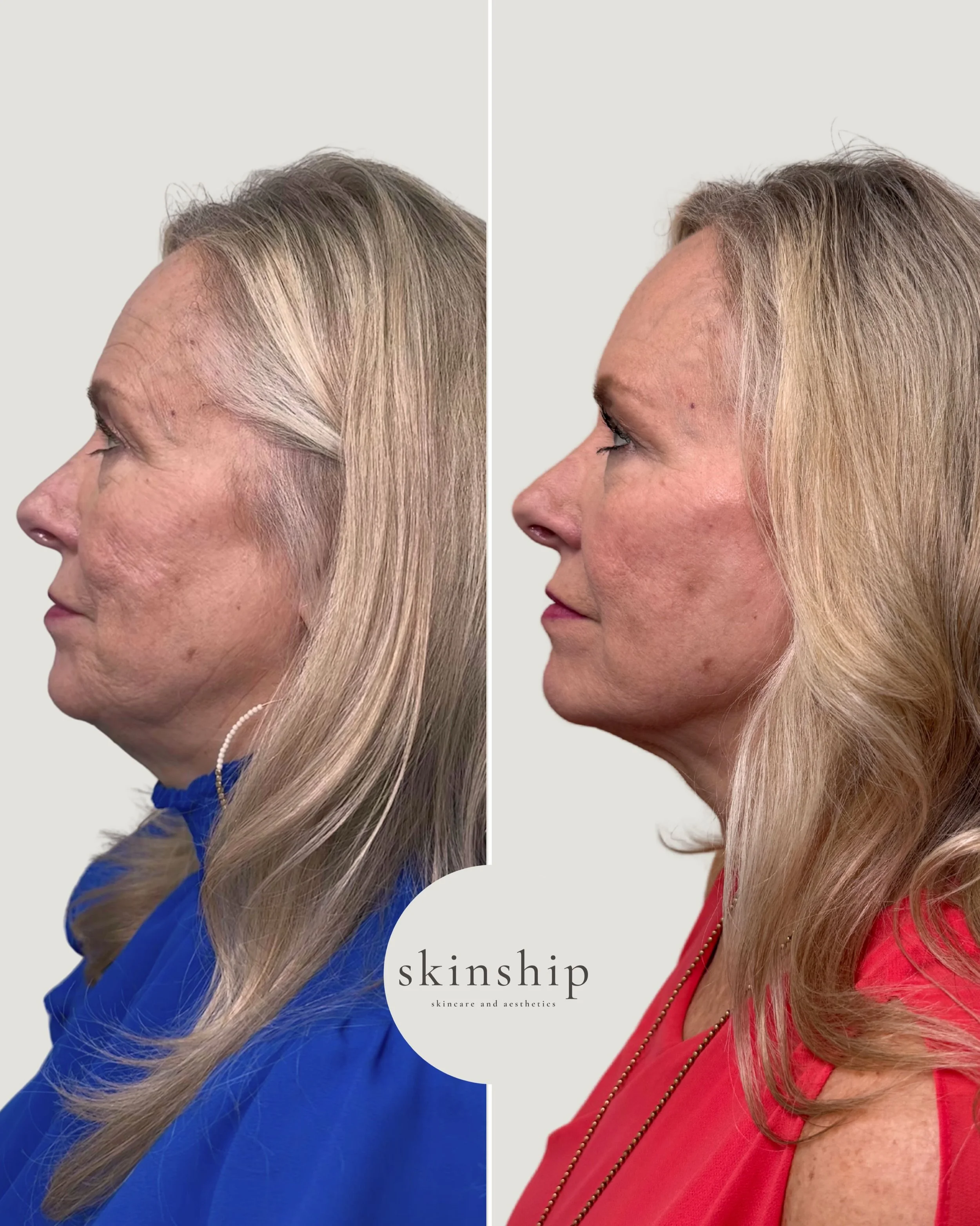 A lifted, refreshed profile. All without surgery. 👏

This transformation was created with a strategic combination of cheek + midface filler and tox, including a Nefertiti neck lift, to restore support through the midface and create a more lifted, de