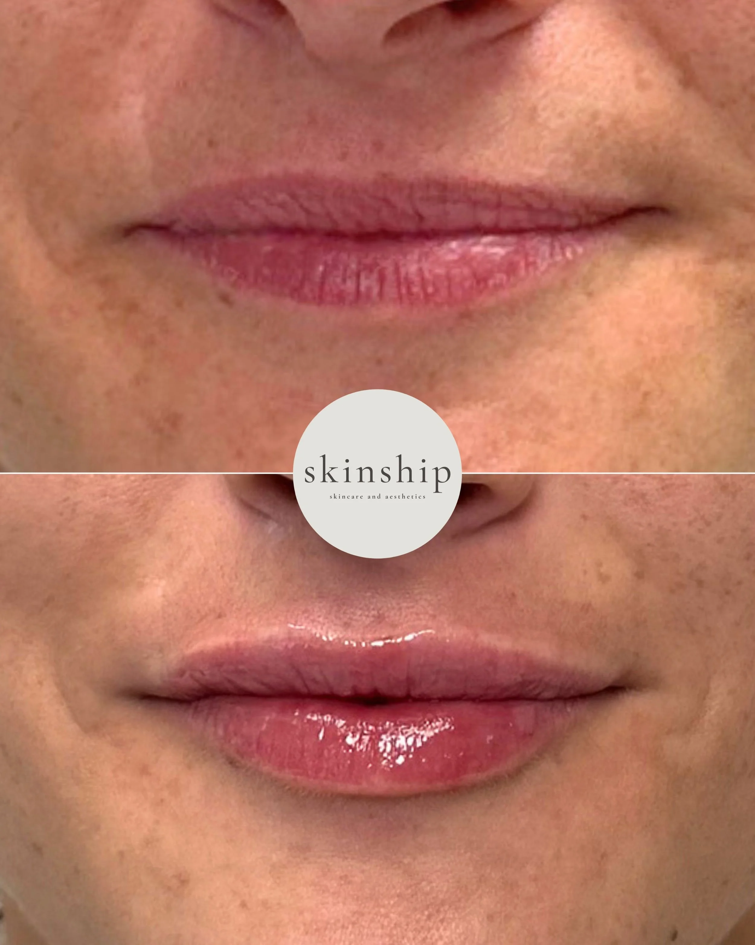 A little hydration, a little definition, a little balancing act 💋

The goal here wasn&rsquo;t bigger,  it was subtle hydration, more defined borders, and balancing asymmetry while keeping her natural lip shape.

Sometimes the smallest tweaks make th