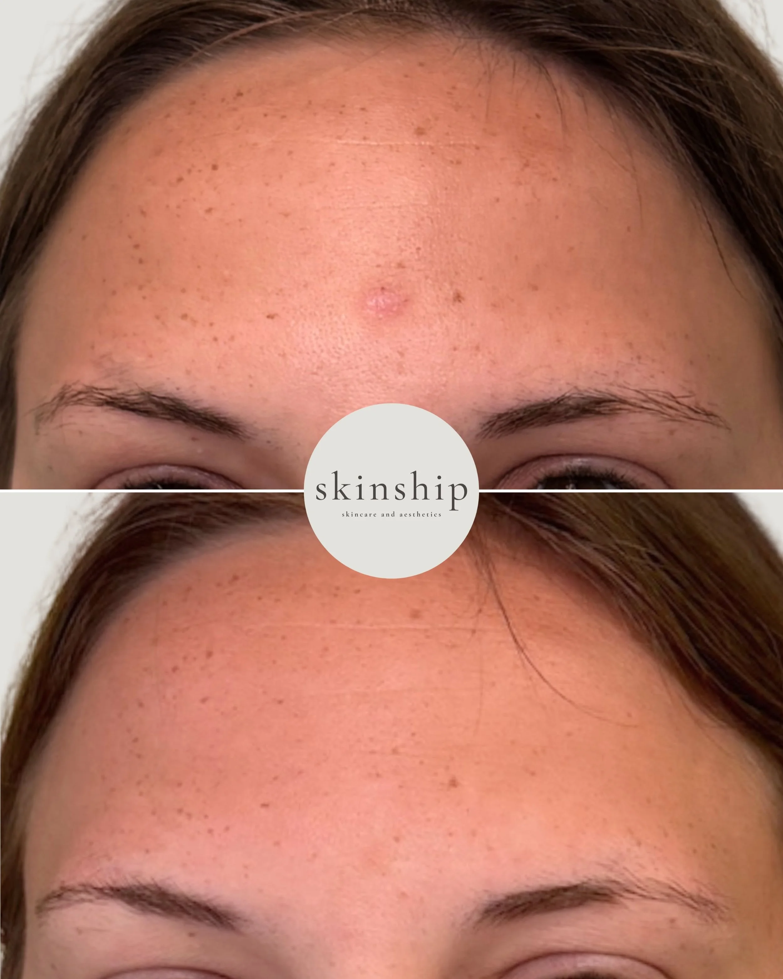 Just two weeks after microneedling for acne scarring 👏

Microneedling helps stimulate your skin&rsquo;s natural collagen production to improve the look of acne scars + texture over time. 

The best part? Microneedling also helps improve fine lines, 