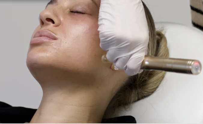 Microneedling in Buckhead &amp; Atlanta: What Actually Happens, Session by Session
