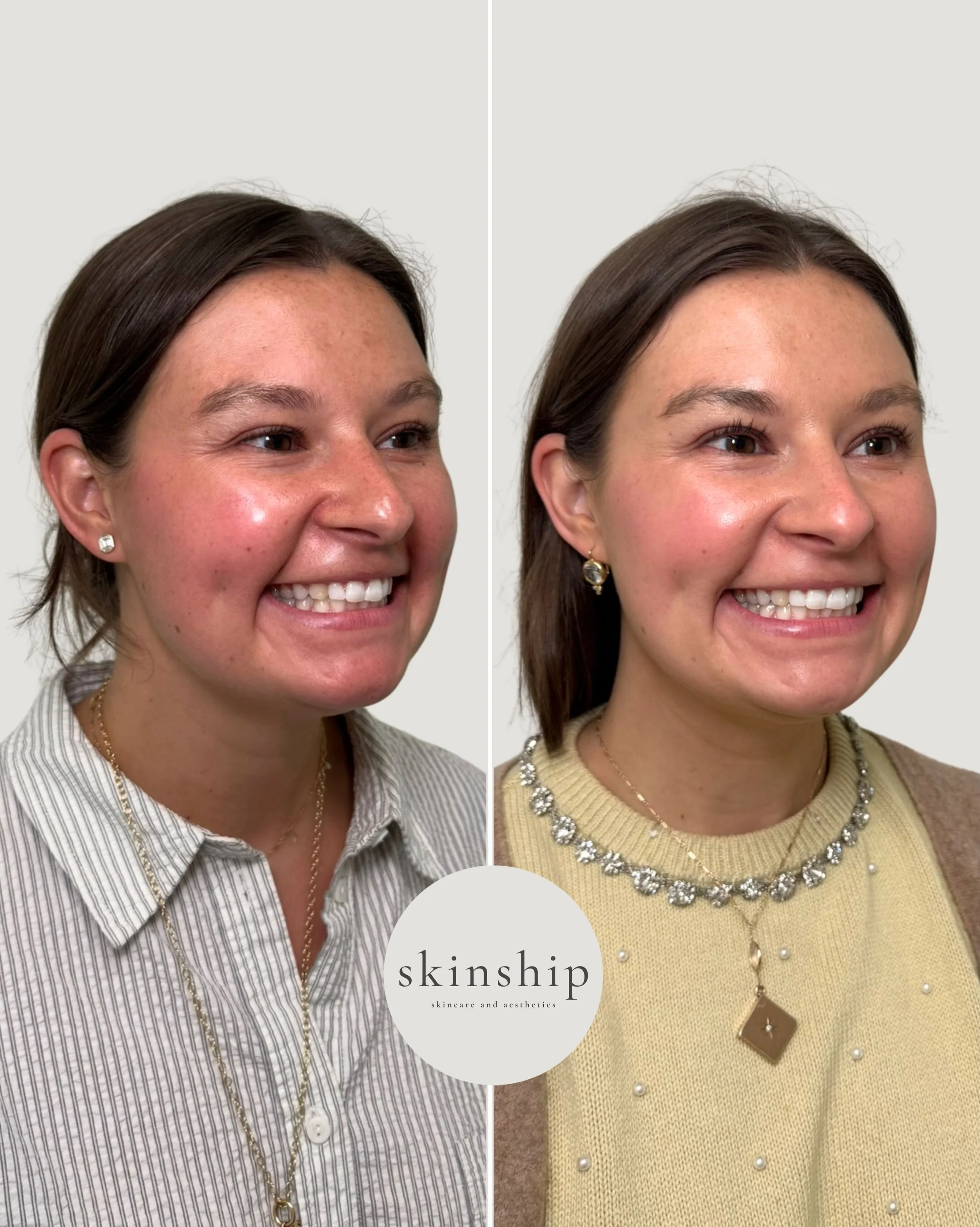 Bridal prep starts with good skin. ✨

A series of microneedling treatments with PRP gave her a smooth, glowy base, while a little Dysport helped soften expression lines while still keeping her natural expression.

Fresh, glowy, and still completely h