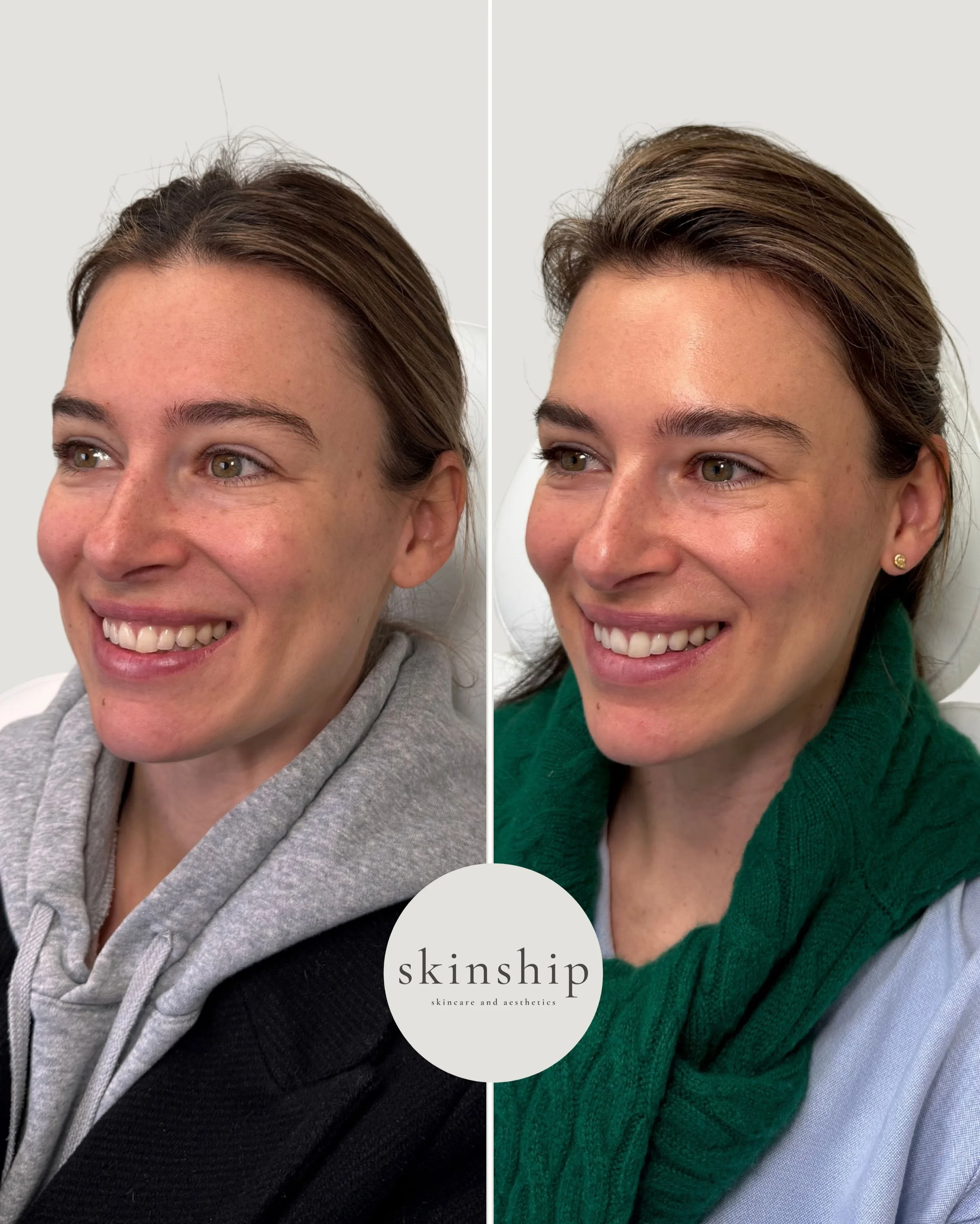 Less lines, but still you 

We love Dysport to soften expression lines for a subtle refresh we&rsquo;ll choose every time for a natural look. No downtime, about 2 weeks to settle in, and still very much your face.

Click the link in our bio to schedu