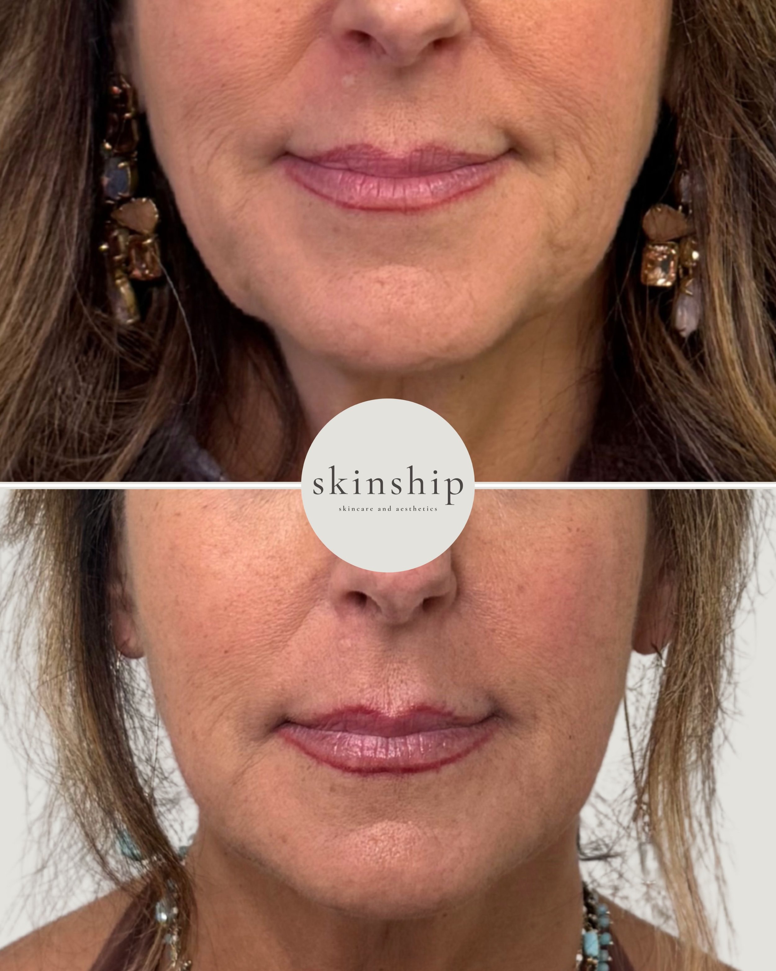 Filler + Botox treat different areas to soften transition zones. In this patient, we used filler in the cheeks, chin, and chin shadows to provide lift and projection and smooth out the jawline and nasolabial folds.

#Botox #Jowls #AntiAging #Filler