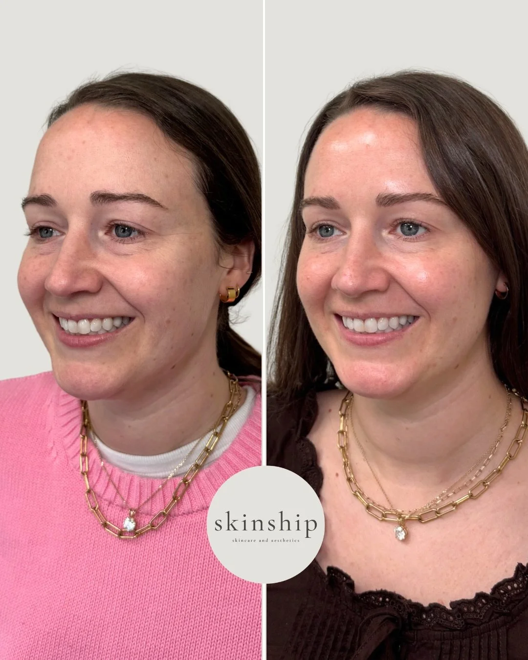 A little regenerative medicine goes a long way. ✨

Microneedling with PRP, PRF undereye injections &amp; a touch of Dysport for smoother skin, brighter undereyes, and a naturally refreshed look.

Ready for your refresh? Schedule a consultation at the