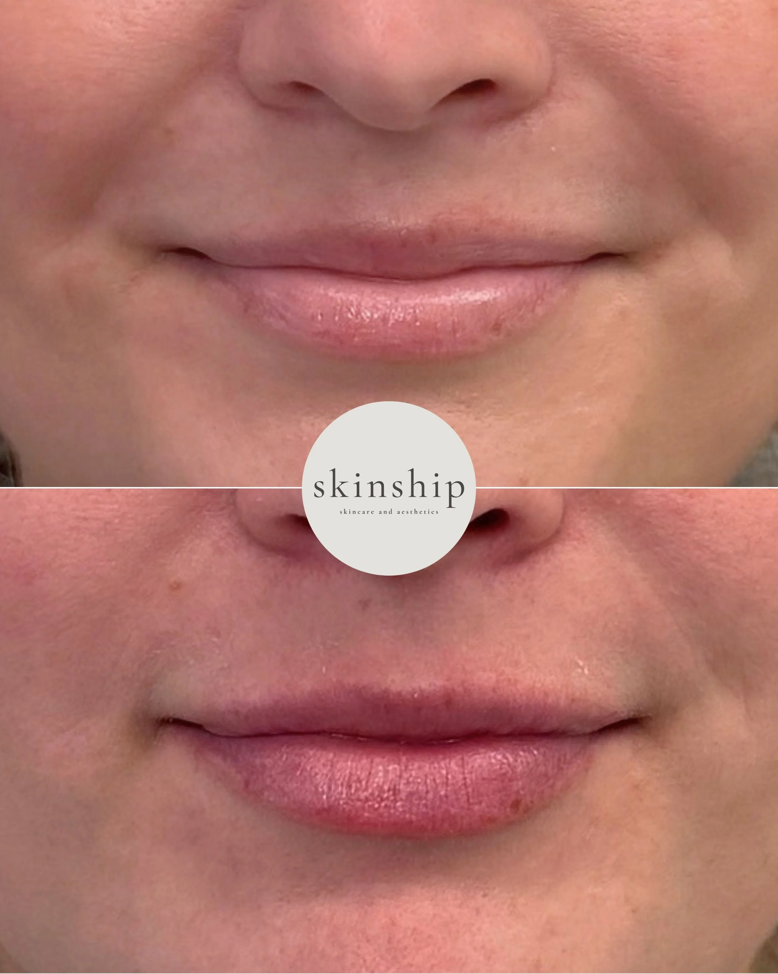 Lip filler doesn&rsquo;t have to mean big, dramatic changes 🤍

After starting with a lip flip, we added subtle volume to refine the upper lip shape while keeping everything soft and natural.

Sometimes the smallest adjustments make the prettiest dif