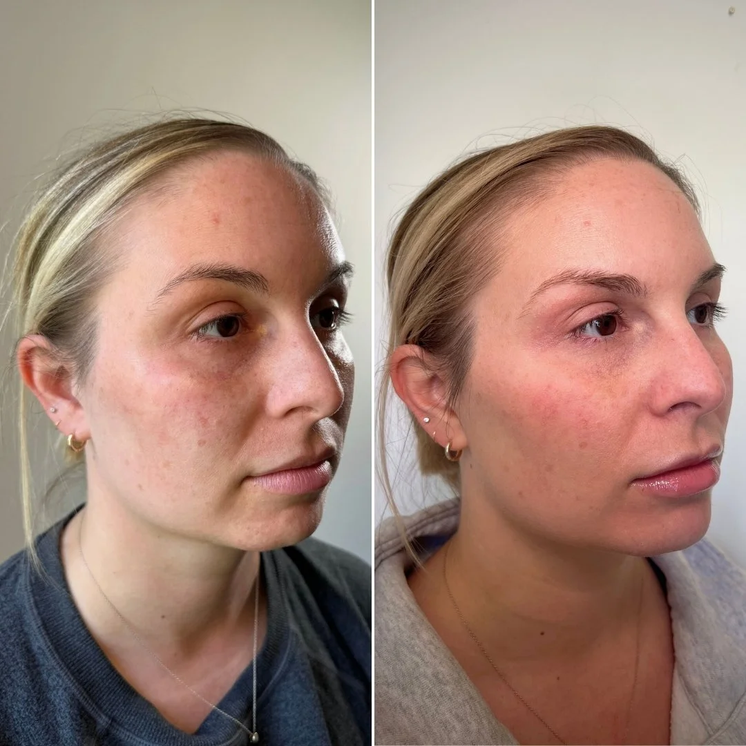 Cheek, Chin, + Lip Filler