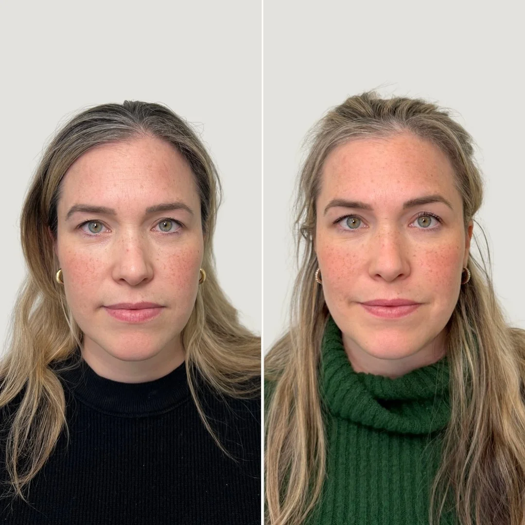 After 1 PRF Undereye Treatment + 1 PRP Treatment for the Face